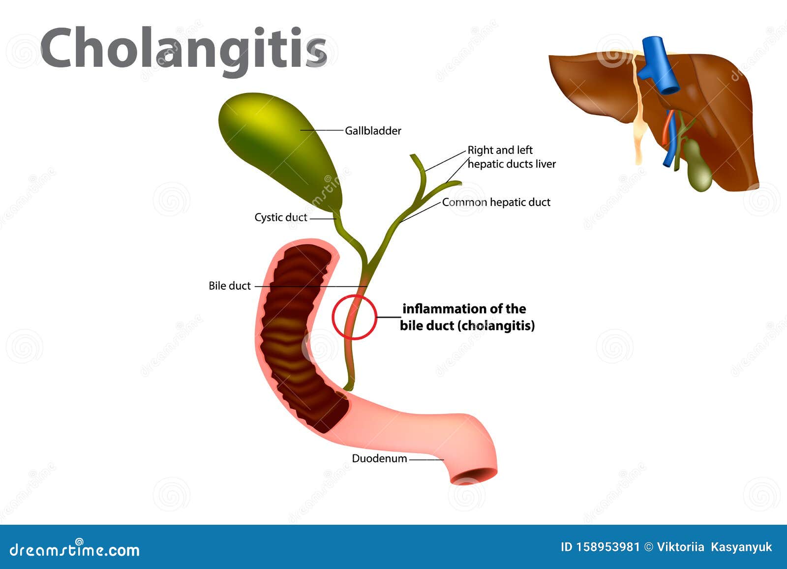 inflammation of the bile duct