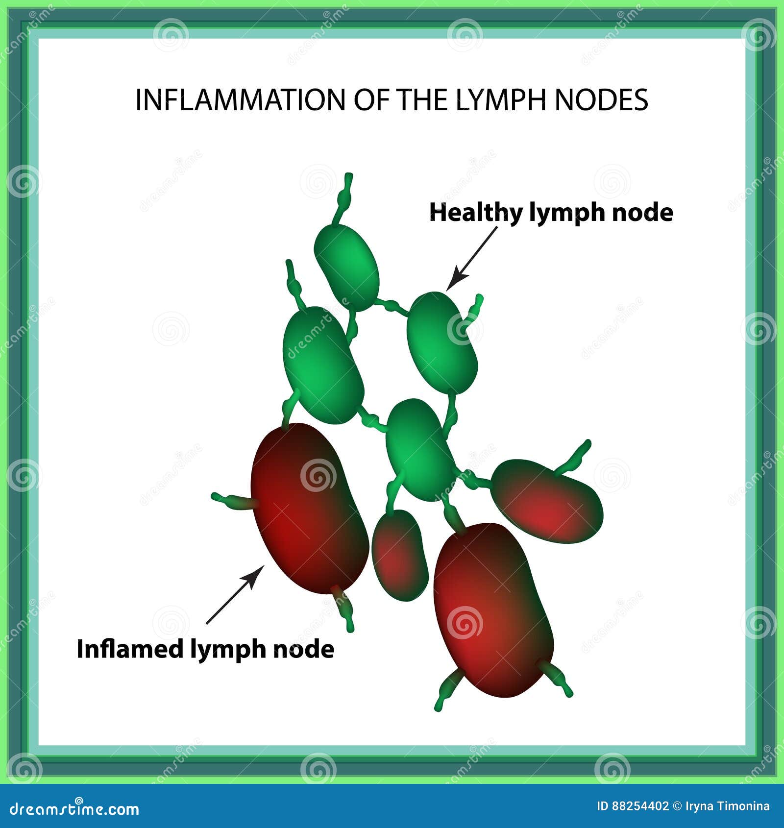 Inflammation Des Ganglions Lymphatiques Infographie Illustration De