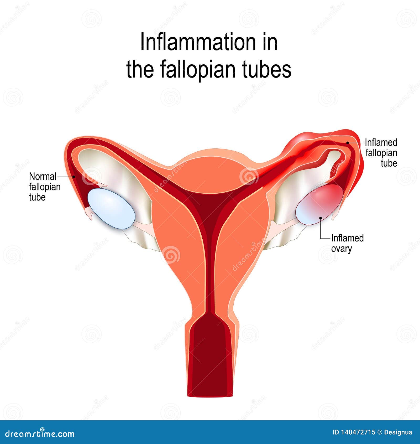 Salpingitis. Inflammation Of The Fallopian Tube. Oophoritis. Inflammation  Of The Ovary. Pelvic Organs. Infographics. Vector Illustration On Isolated  Background. Royalty Free SVG, Cliparts, Vectors, and Stock Illustration.  Image 68281130.