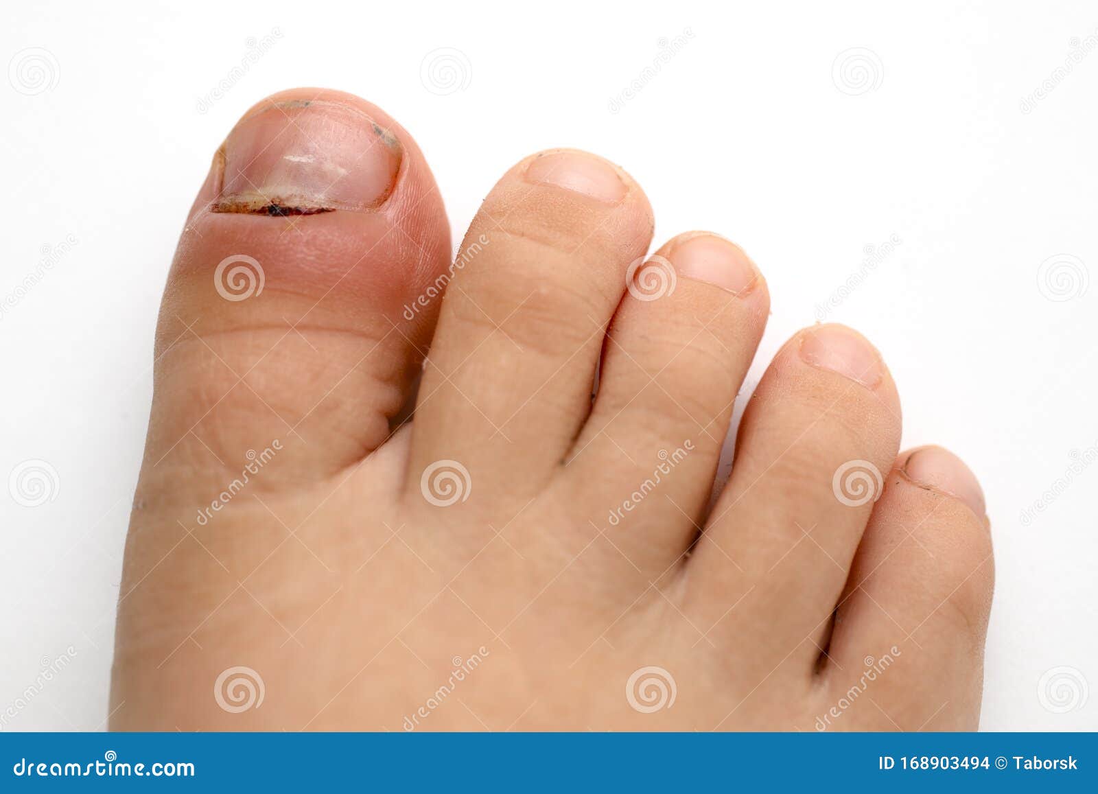 The Different Types of Fungal Nail Infection and How They Present -  Podiatry HQ