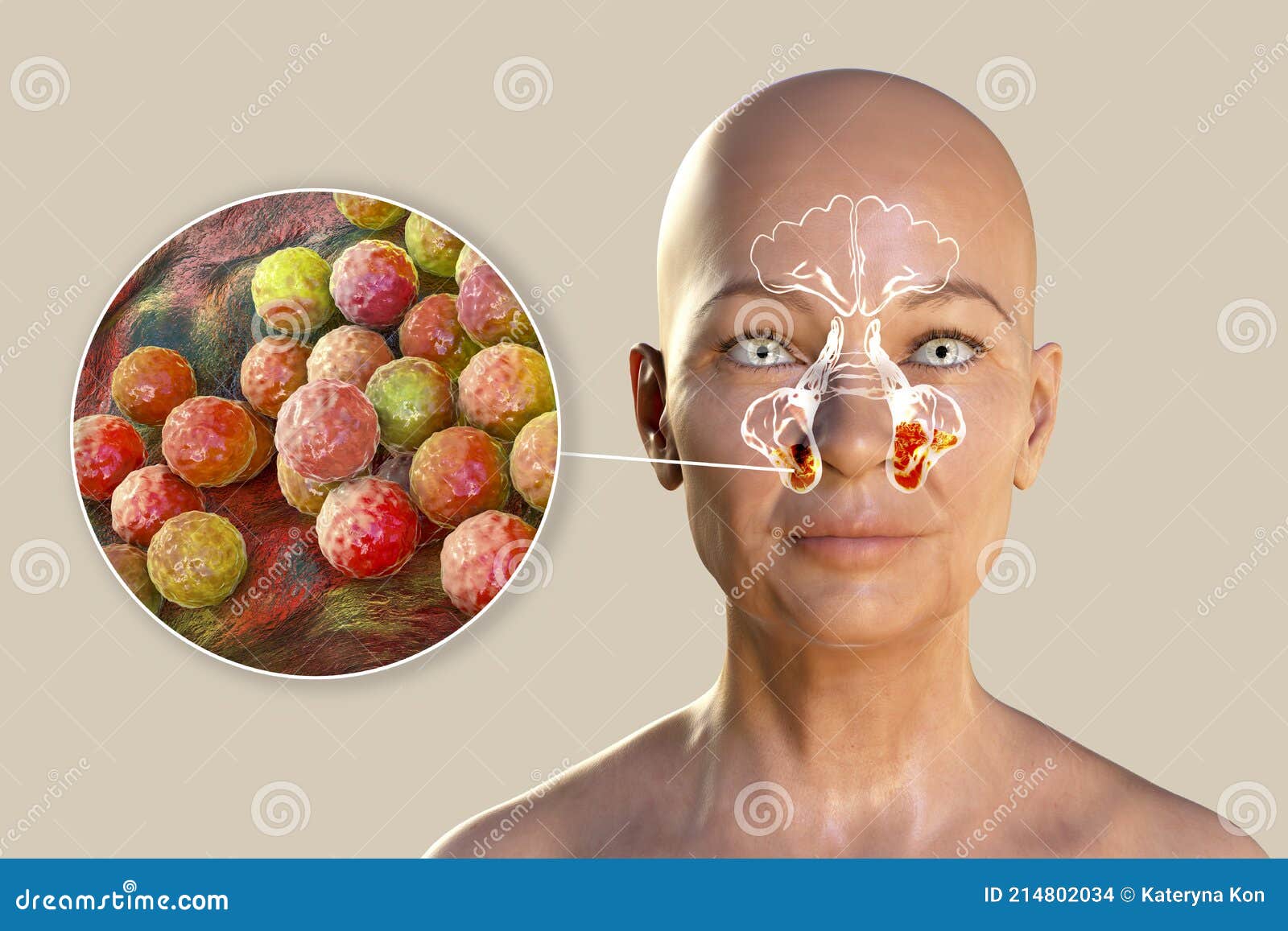 Inflammation of Frontal Sinuses and Closeup View of Staphylococcal
