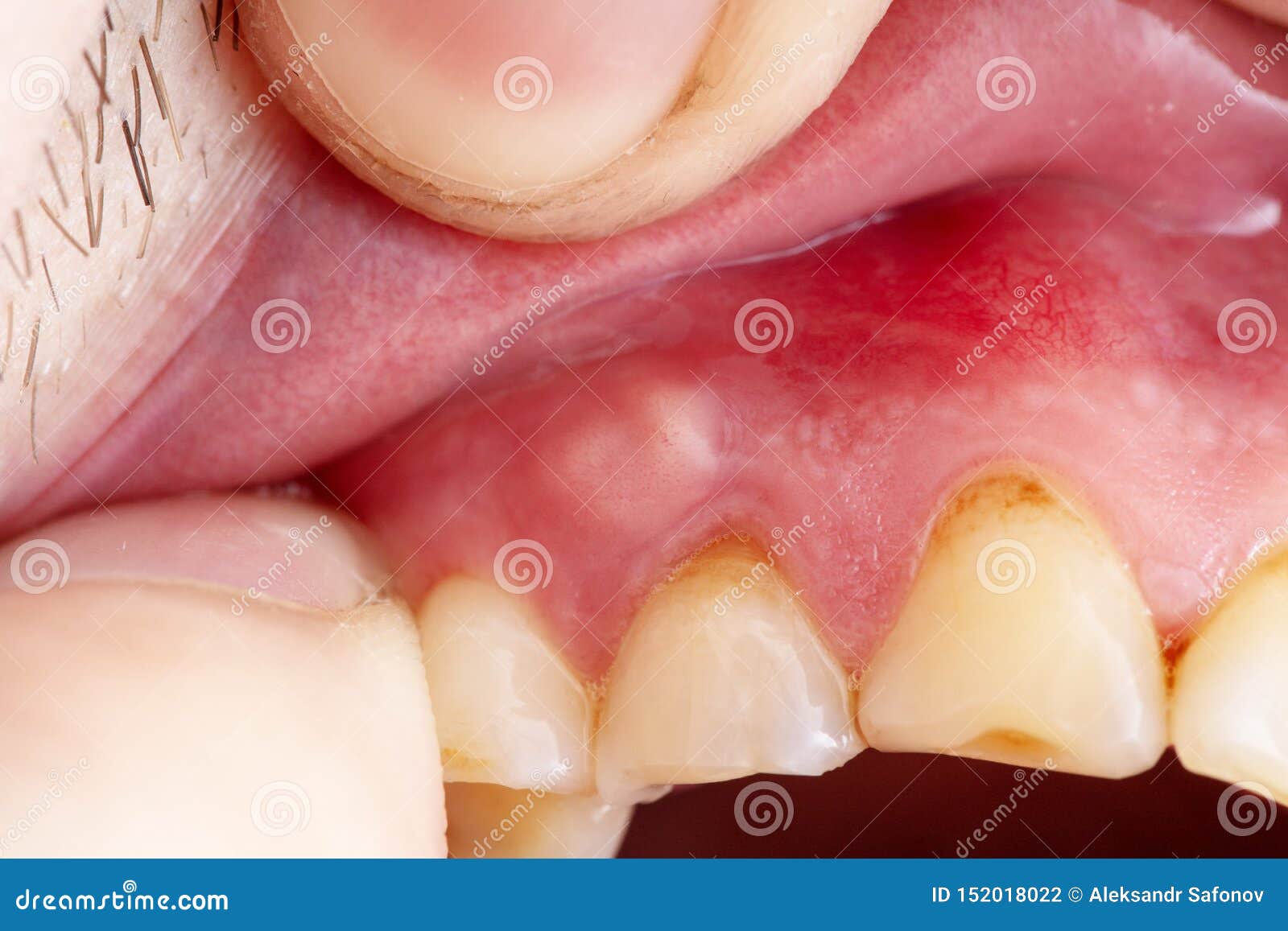 pathological fear of gums pathological fear of gums