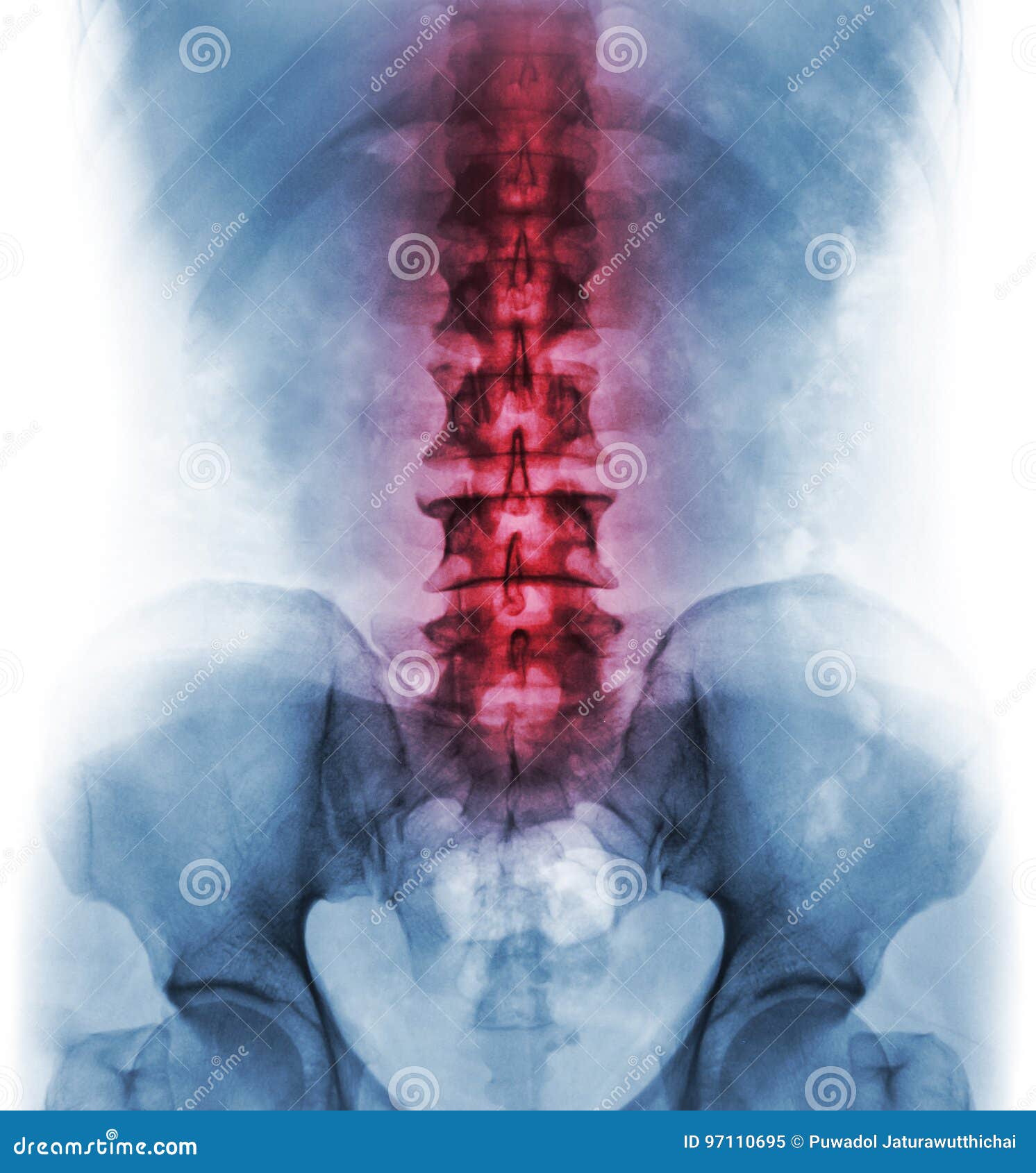 inflammation of lumbosacral spine . concept of vertebral care
