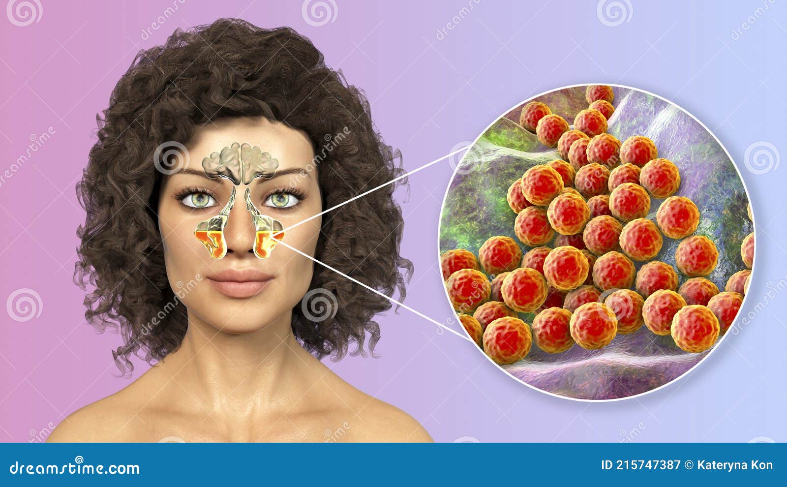 Inflammation of Maxillary Sinuses and Closeup View of Staphylococcal