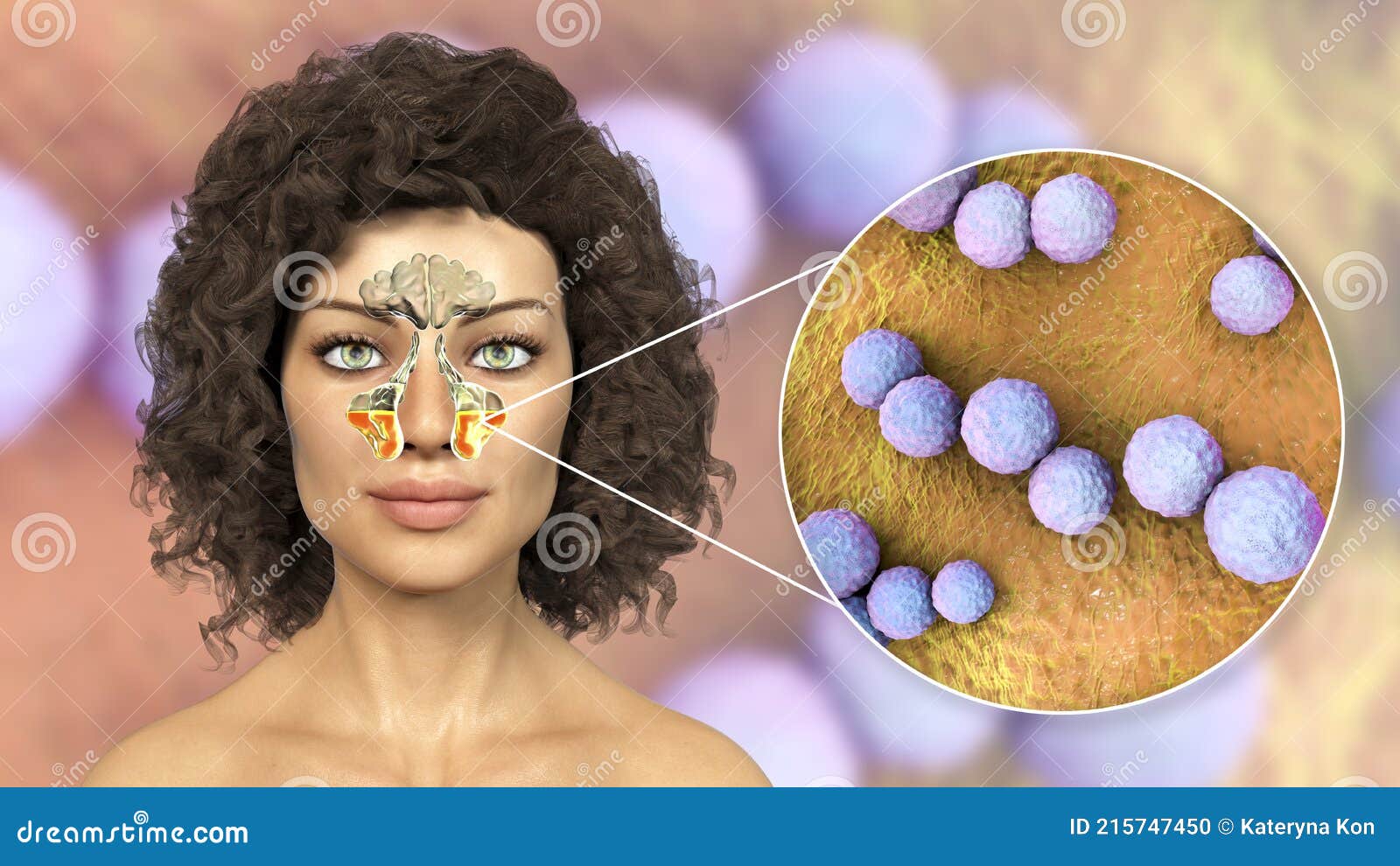 Inflammation of Maxillary Sinuses and Closeup View of Streptococci