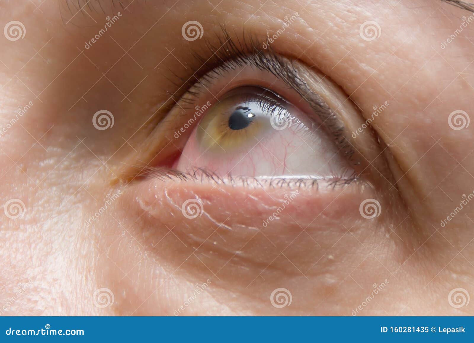 red ring around pupil of eye red ring around pupil of eye