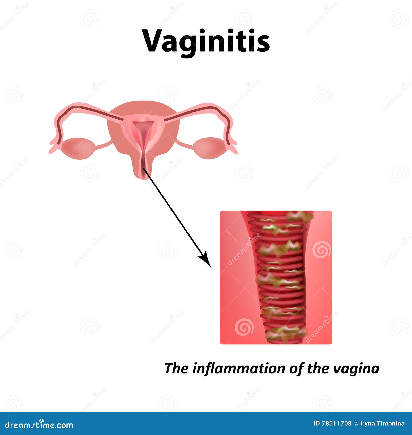 inflammation of the vagina. vaginitis. infographics.   on background