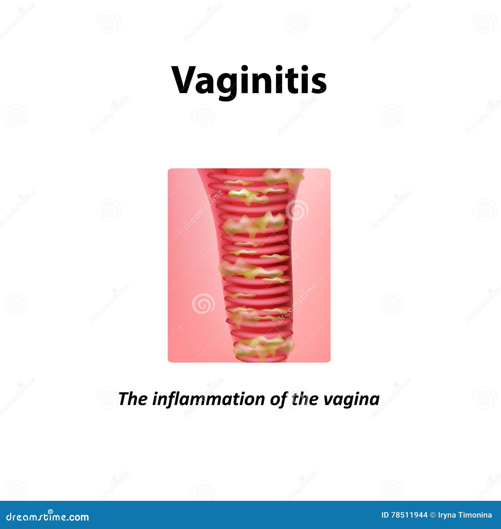 inflammation of the vagina. vaginitis. infographics.   on background
