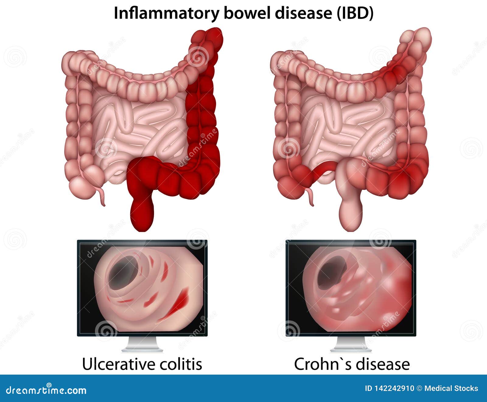 inflammatory bowel disease medical   on white background