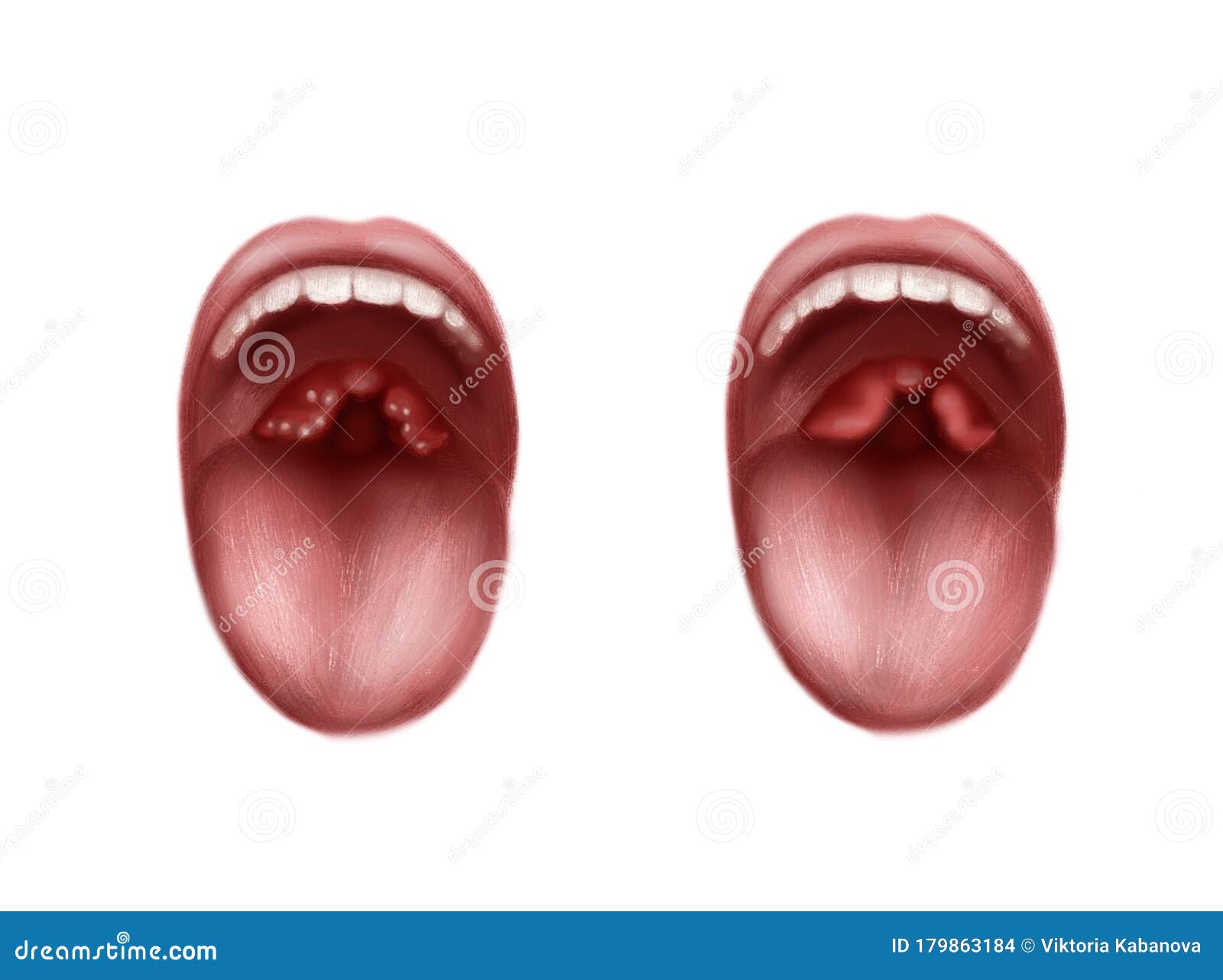 inflammatory diseases of the throat