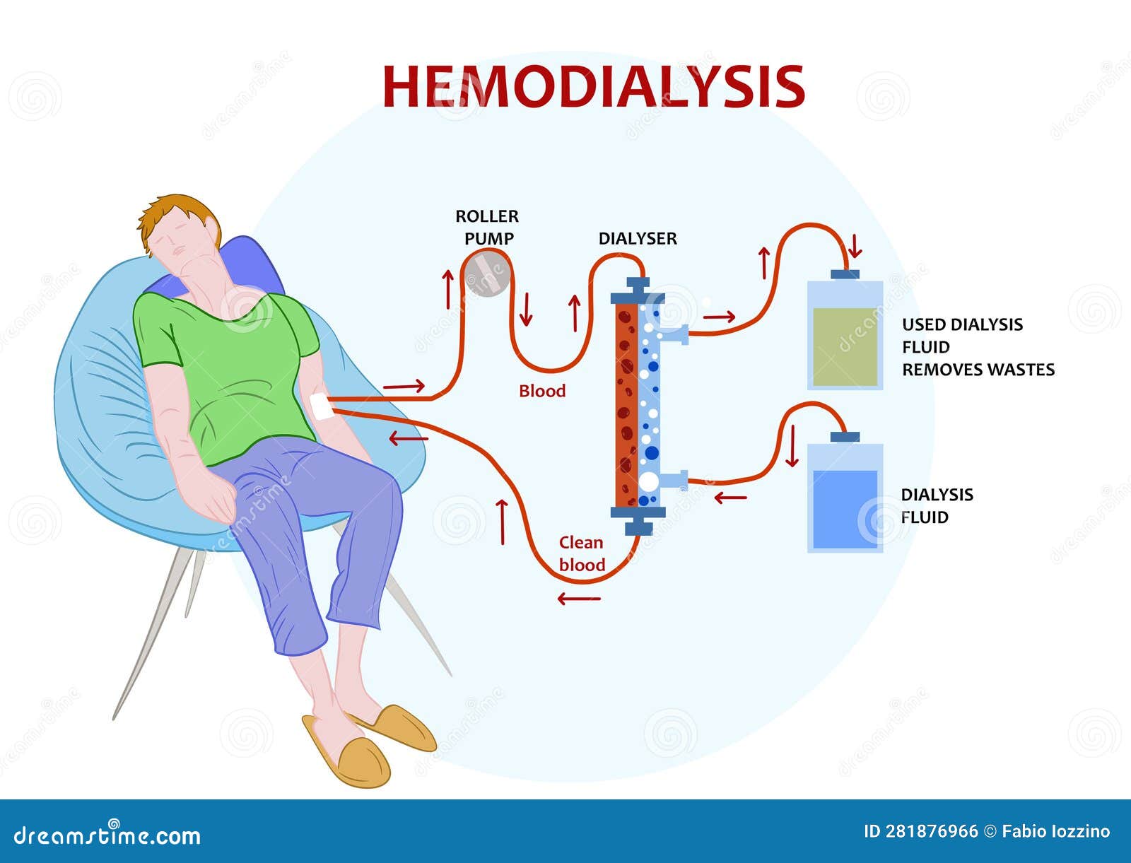 Infographic of Hemodialysis, a Procedure Where a Dialysis Machine are ...