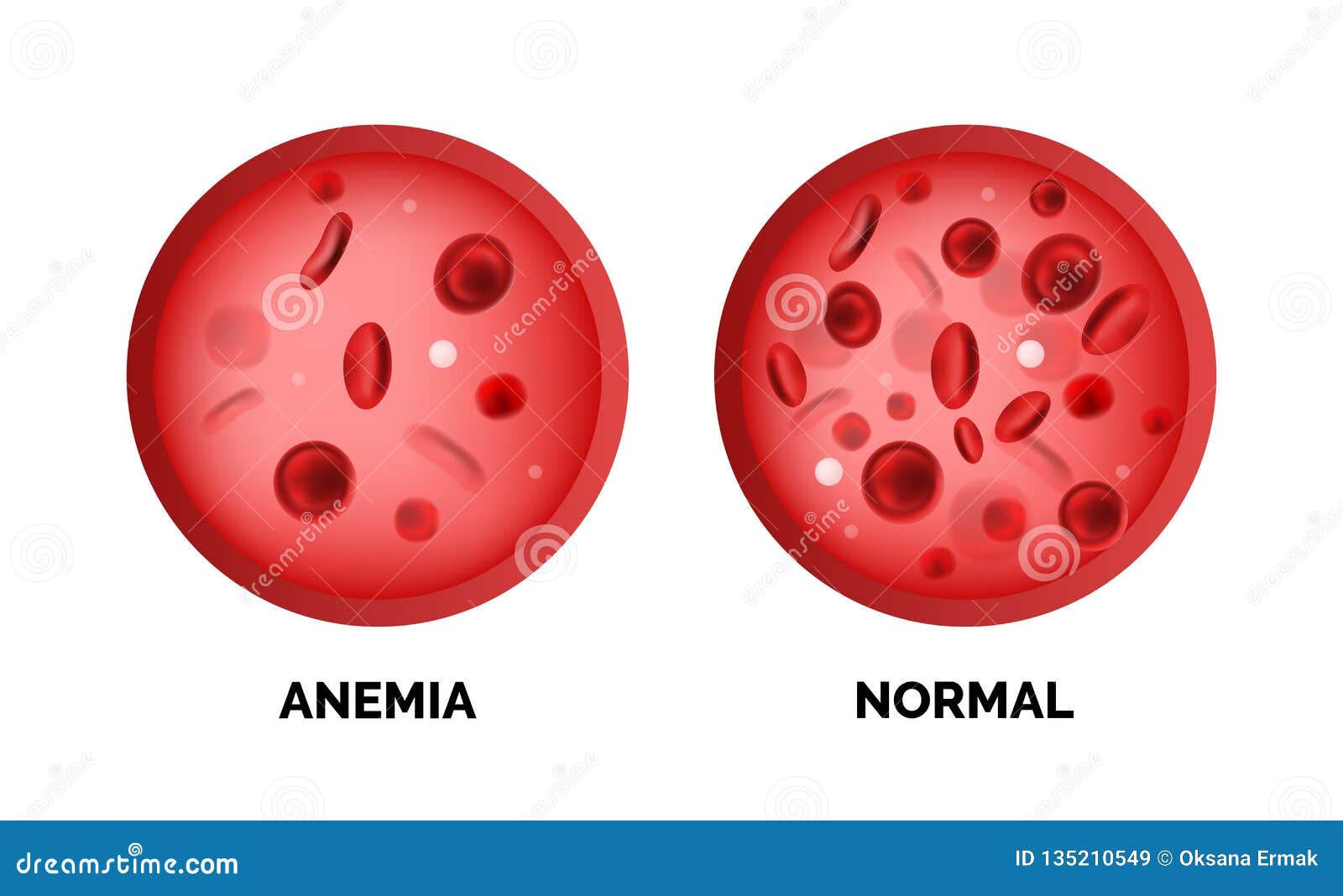 Thalassemia Cartoon Vector | CartoonDealer.com #42273135
