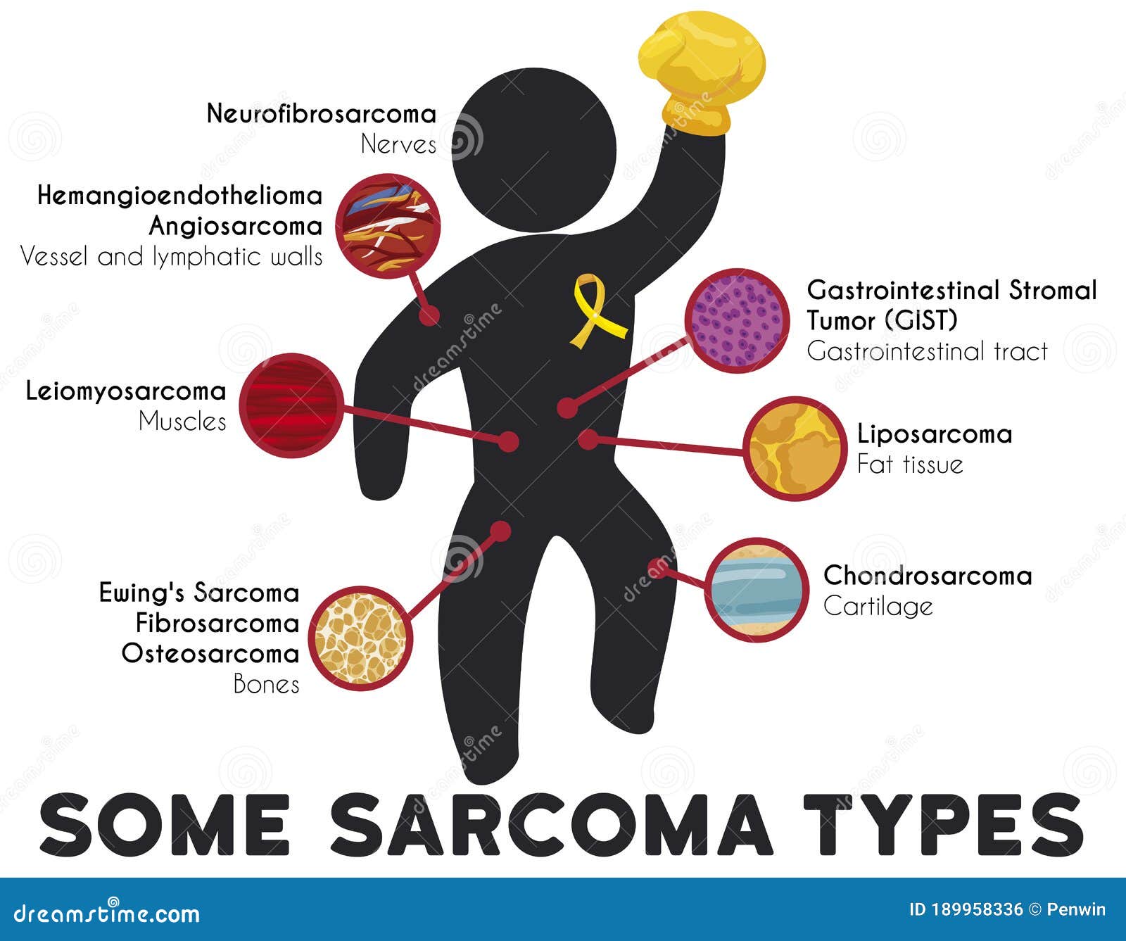 Infographic Showing Some Sarcoma Types And Principal Affected Tissues