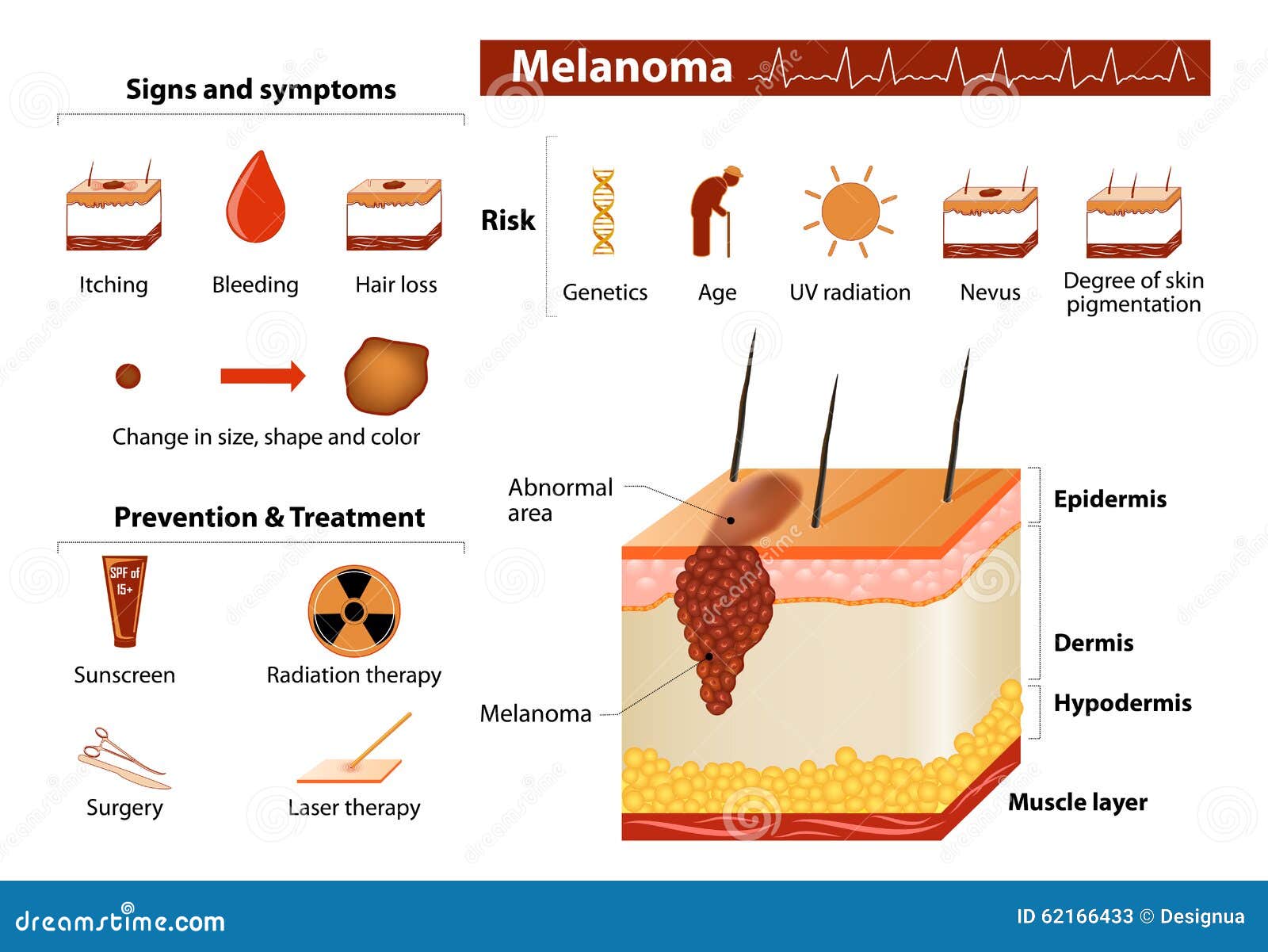 Infographics De Cancer De La Peau Illustration de Vecteur Illustration du anatomie, purge