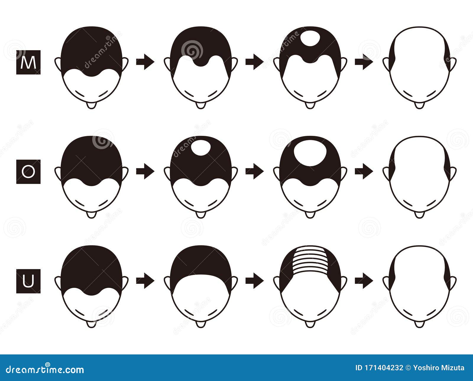 Information Chart of Hair Loss Stages and Types of Baldness Illustrated on  a Male Head Stock Vector - Illustration of person, human: 171404232