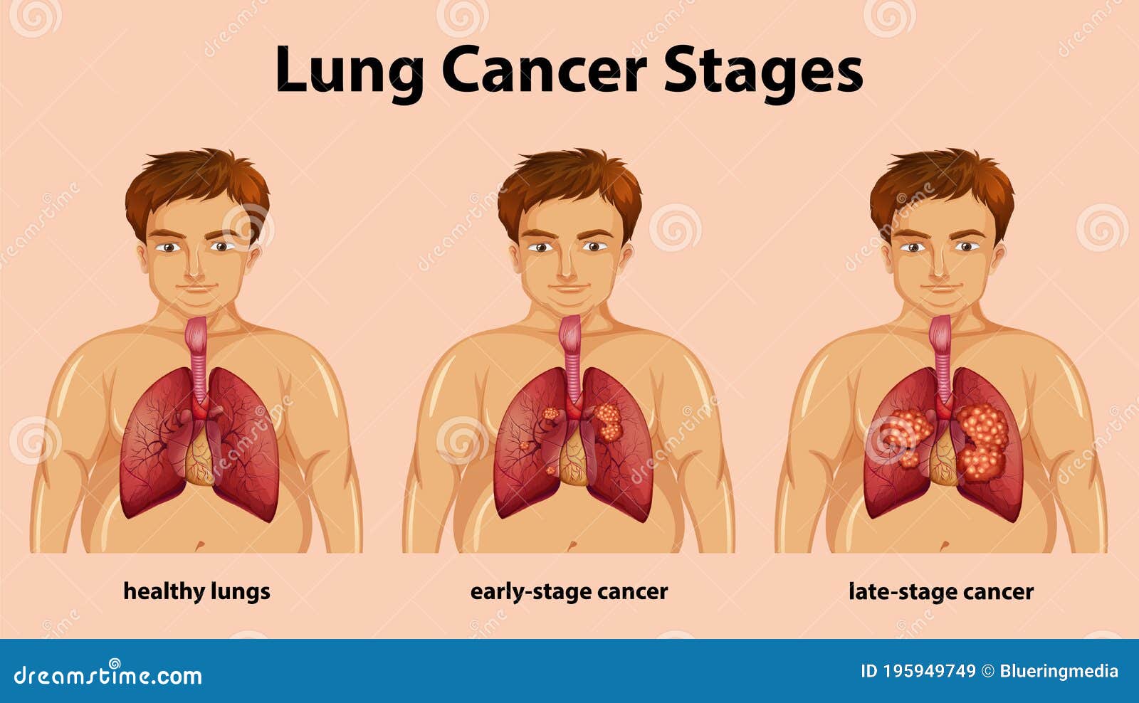 Lung Cancer Progression Timeline