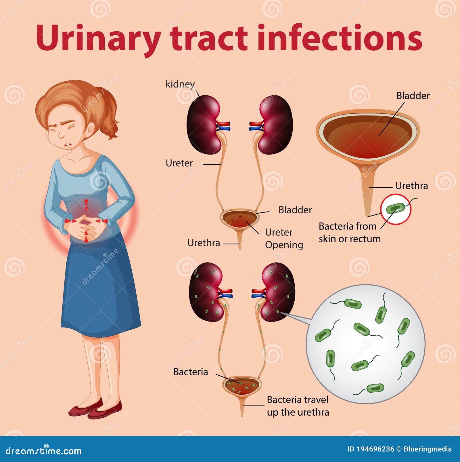 Informative Illustration of Urinary Tract Infections Stock Vector