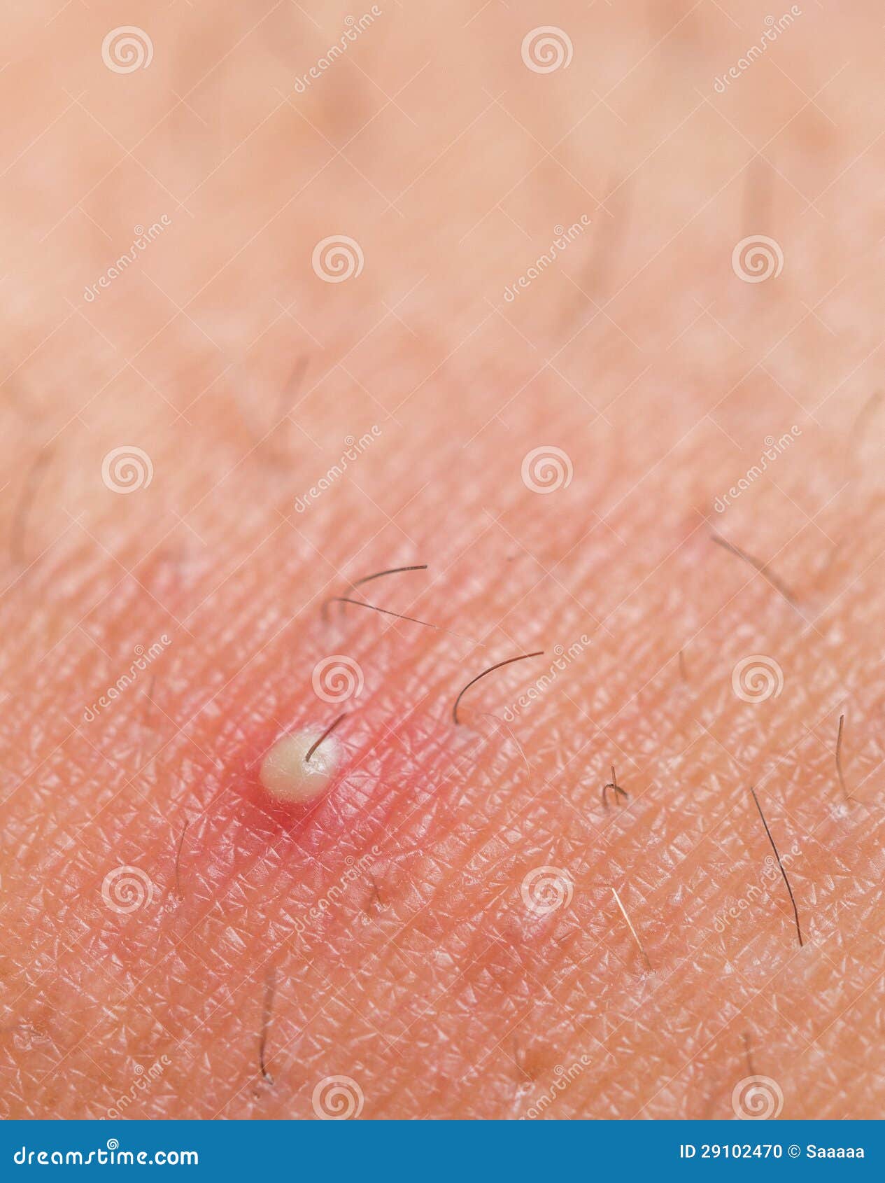 Herpes Pictures HD - Symptoms, Images, Photos and Pictures of Herpes