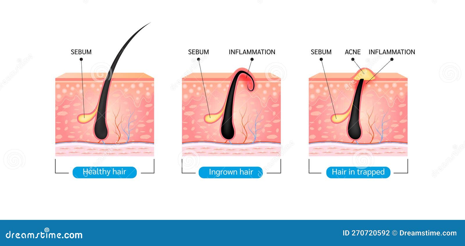 Ingrown Hair. Hair Has Grown Back into the Skin Surface after Shaving ...