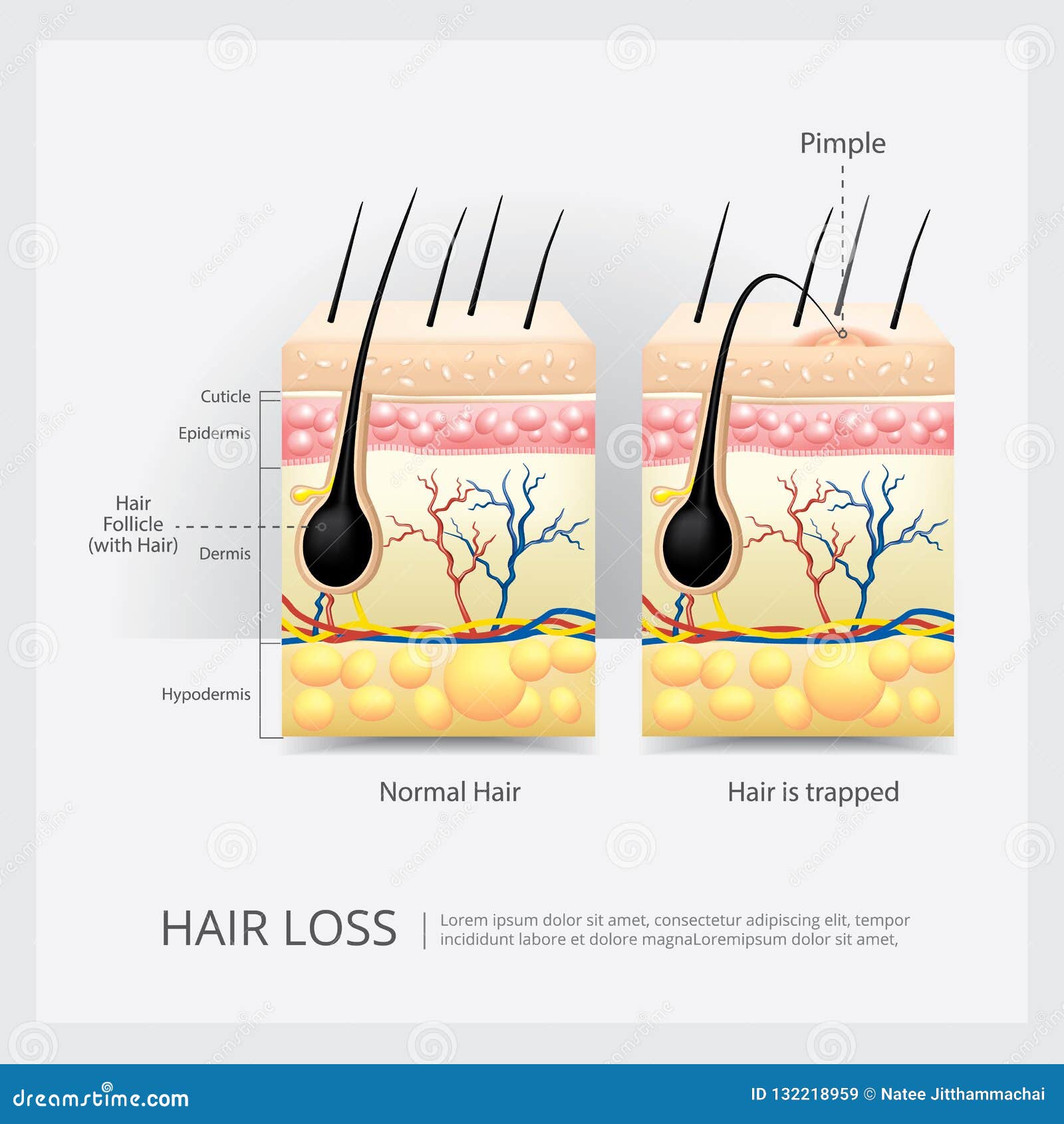 Ingrown Hair Structure stock vector. Illustration of disease 132218959