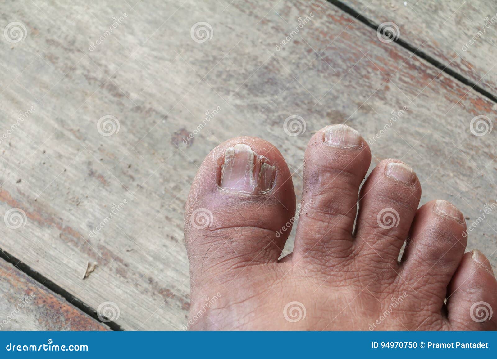 My toe nails keep breaking horizontally 😩😭😭😭 has anyone experienced  this? : r/Nails