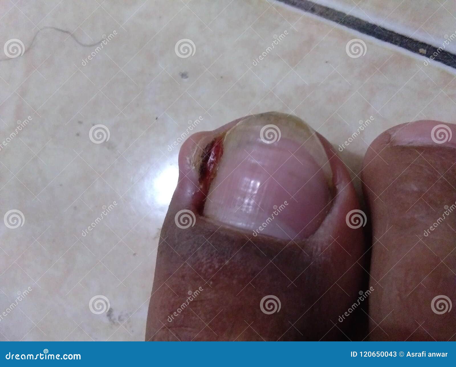 Ingrown nail stock image. Image of nail, thumb, fester 120650043