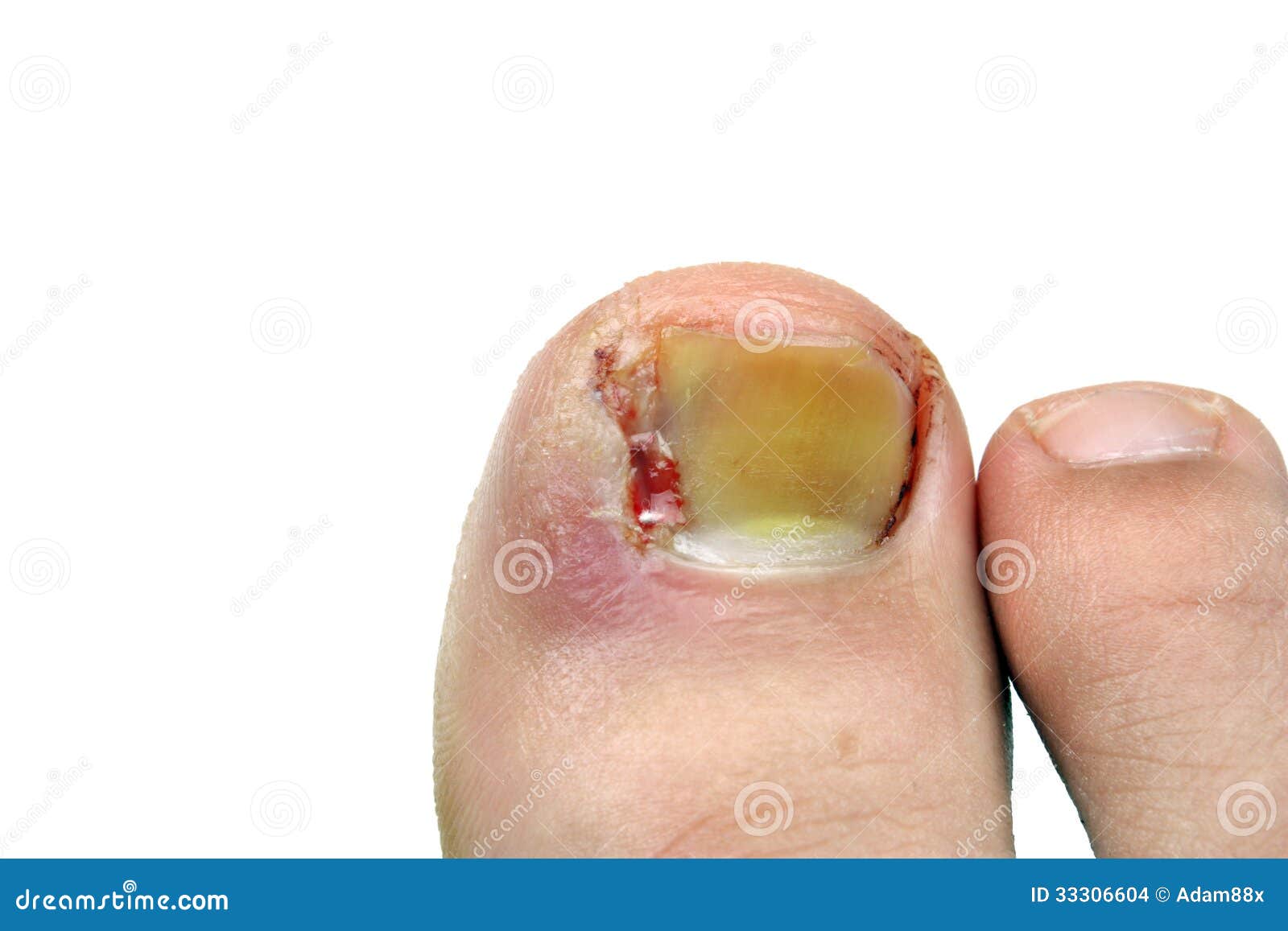 Preventing and Treating Pseudomonas Nail Infections