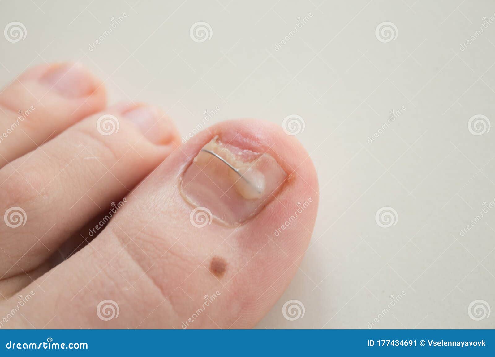 Ingrown Toenail Treatment. the Results of Drugs for the Treatment of Fungal  Infections and Ingrown Nails. Bracket Stock Image - Image of bracket,  beauty: 177434691