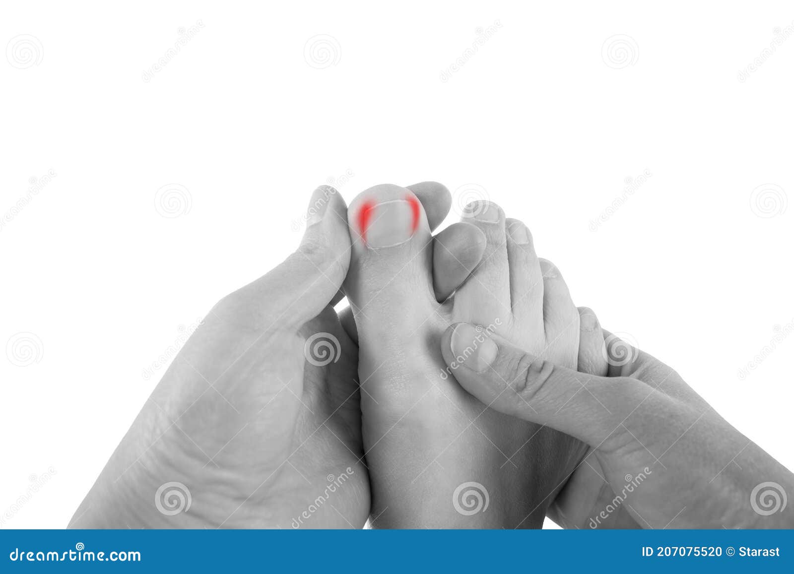 ingrown toenails on a woman`s foot,  on white background, pain in the big toe