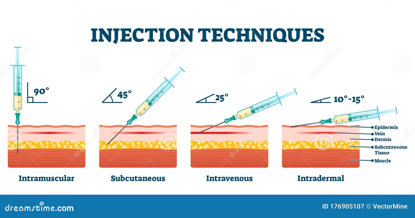 Внутрикожная глубина введения иглы. Глубина введения инъекций. Интрадермальная инъекция. Подкожная и внутрикожная инъекция. Углы введения инъекций.