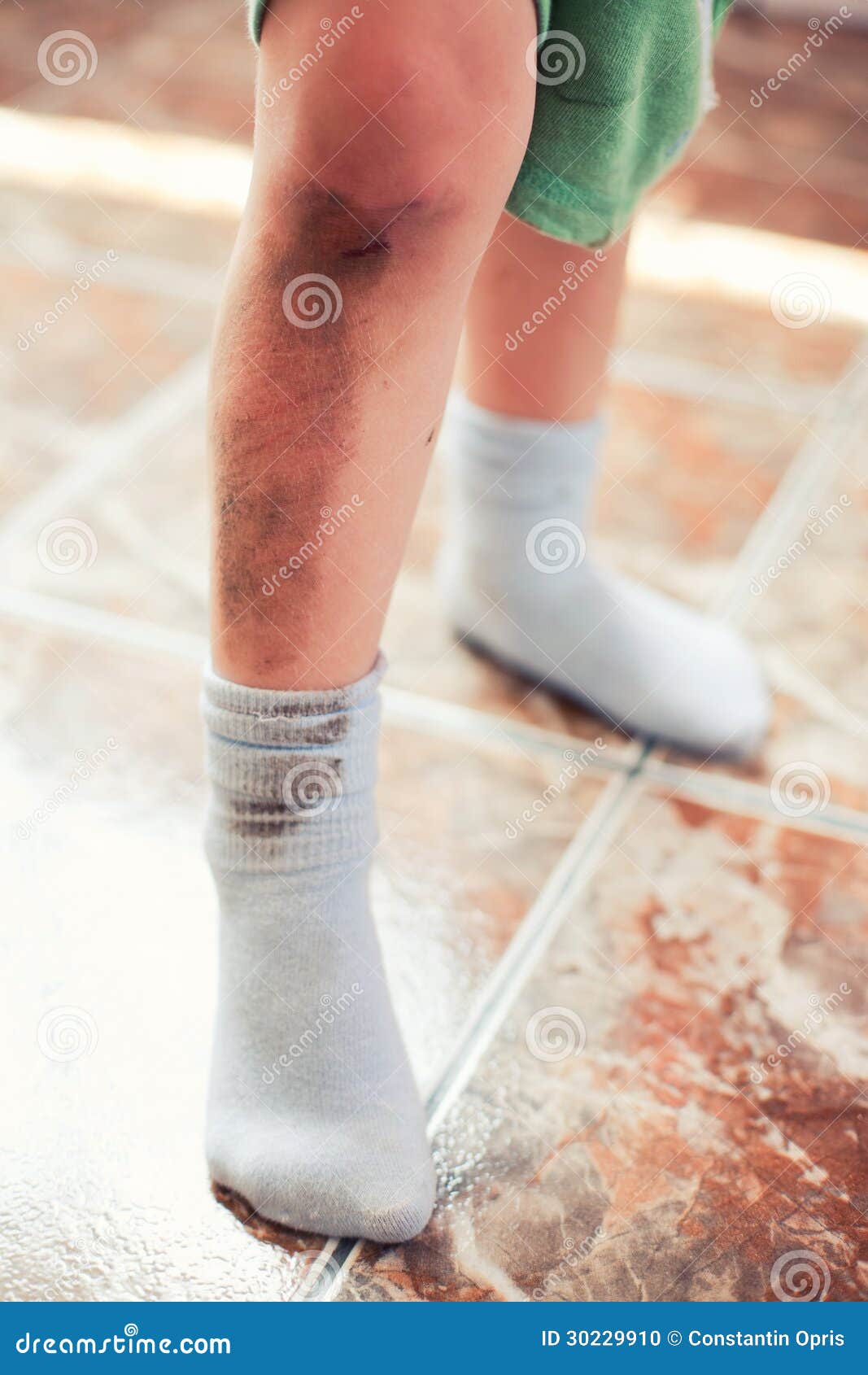 Injured child stock photo. Image of blood, bruise, hurt 30229910