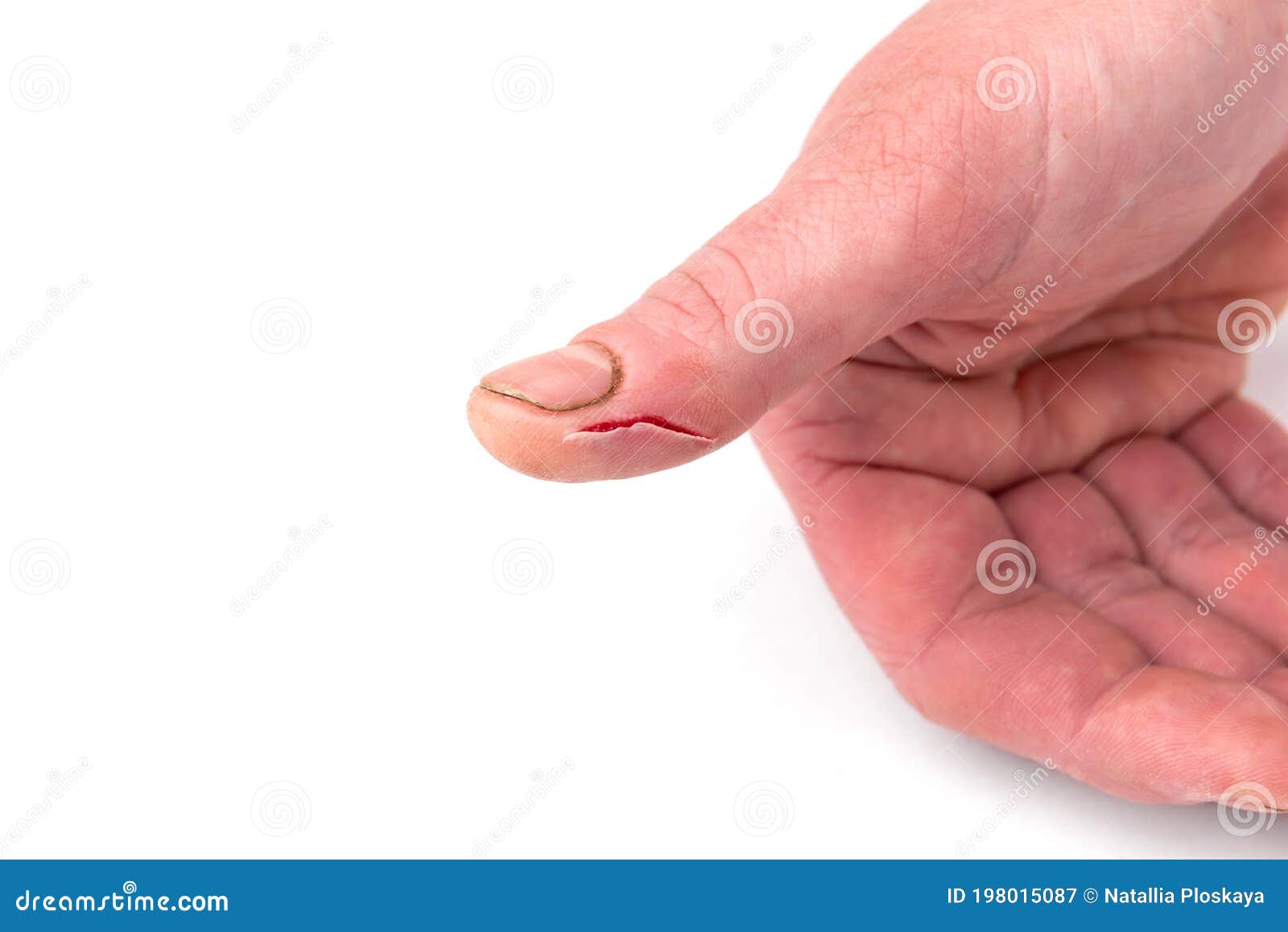 cut fingers cut fingers