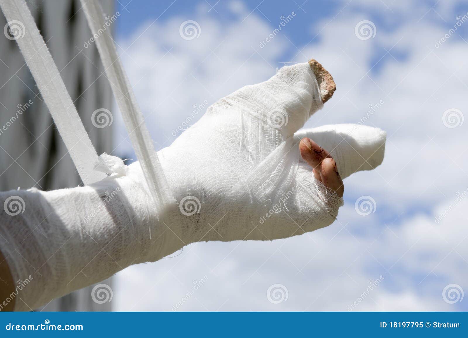 Hand Cast Fractured after an Accident Stock Photo - Image of hand