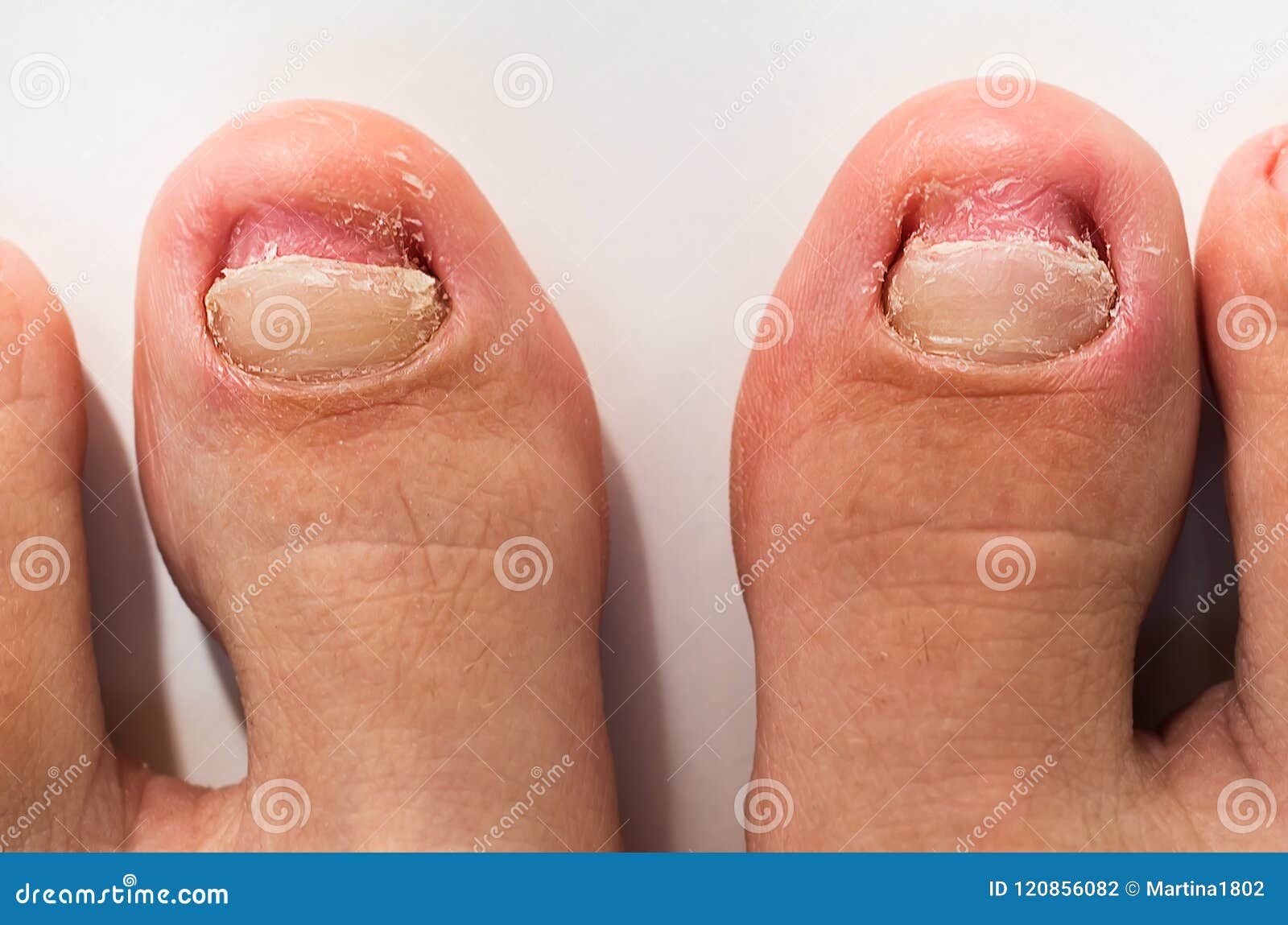 What is the best shape for toenails?: Gotham Footcare: Podiatrists