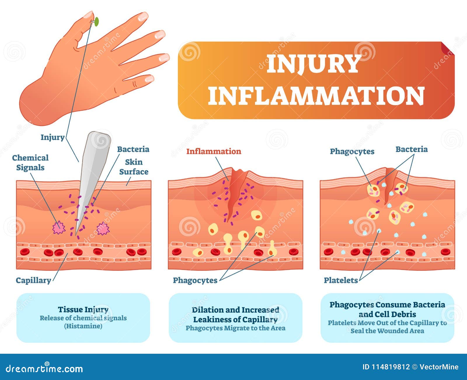 injury inflammation biological human body response   scheme. skin surface injury cross section poster.