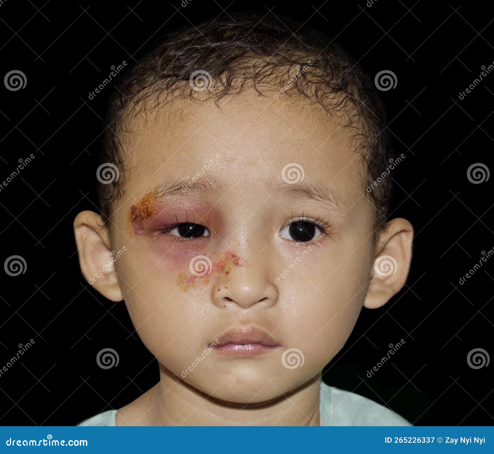Collection 102+ Images photos of impetigo on the face Updated