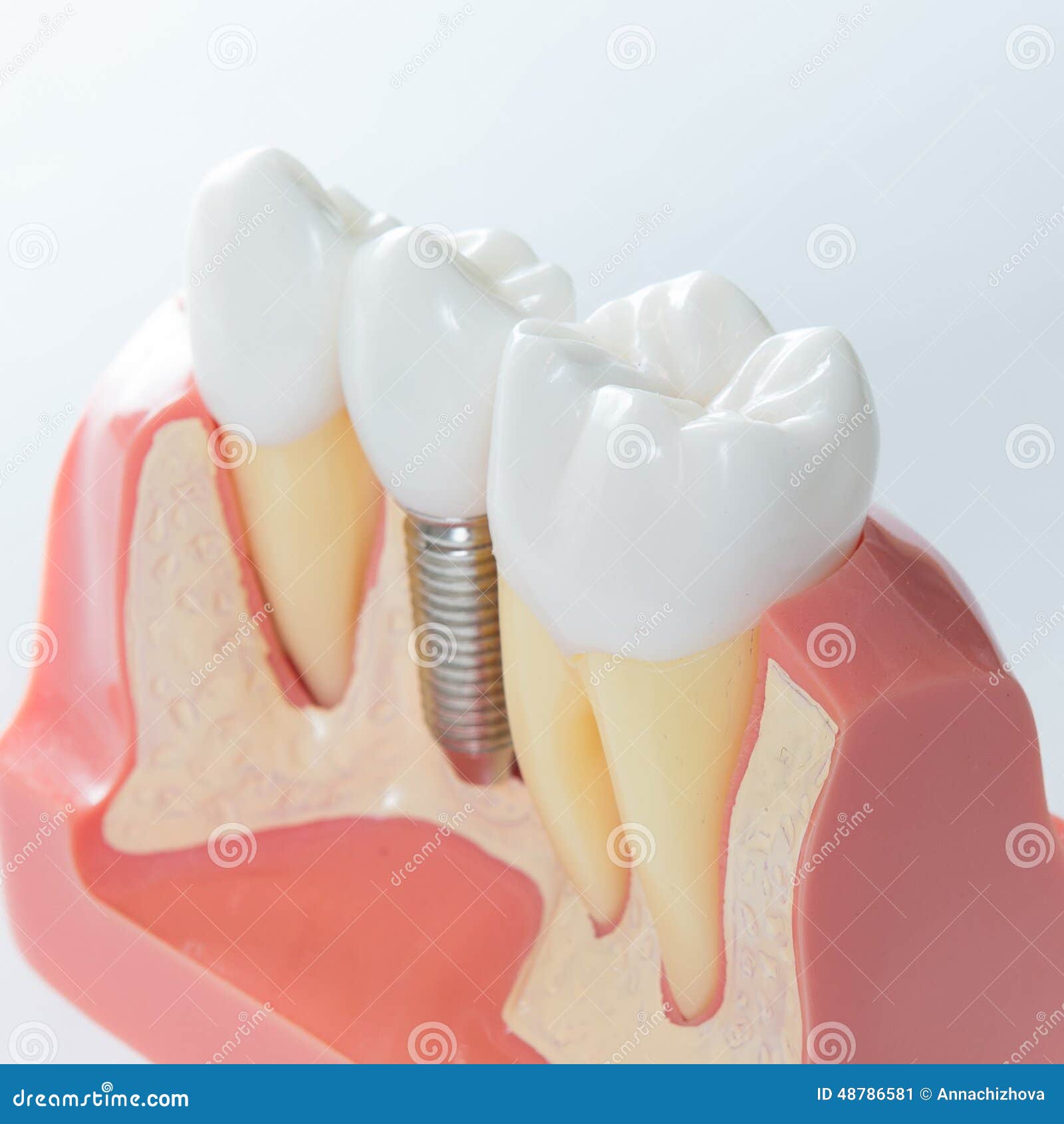 Skull And Bones Ps5 1 Pz Dentale Frantoio Per Ossa Mulino Smerigliatrice Osso Innesto Impianto Aumento Strumento Dentale Nuovo Idropulsore Dentale Portatile - Foto 2