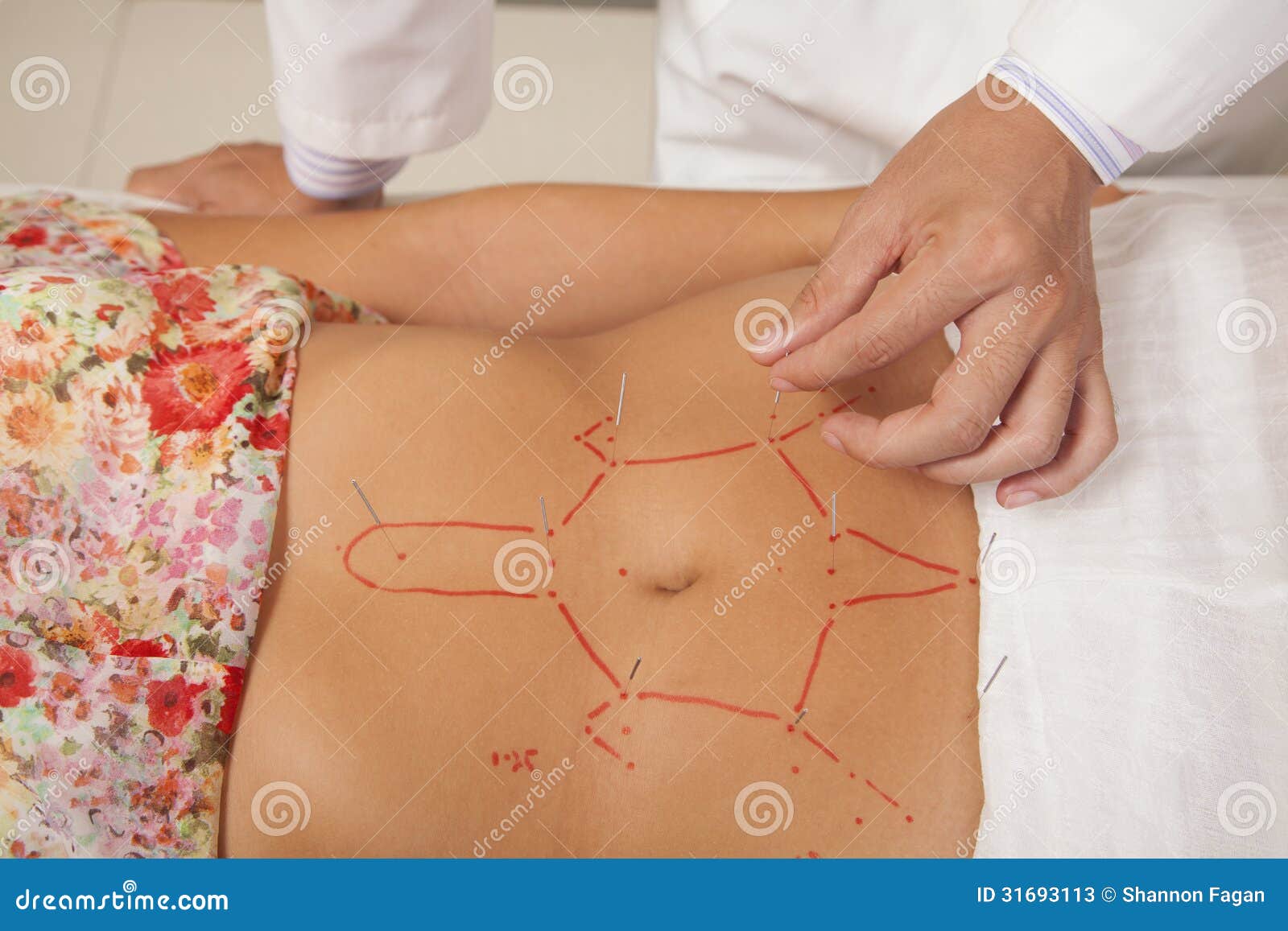 inserting acupuncture needles