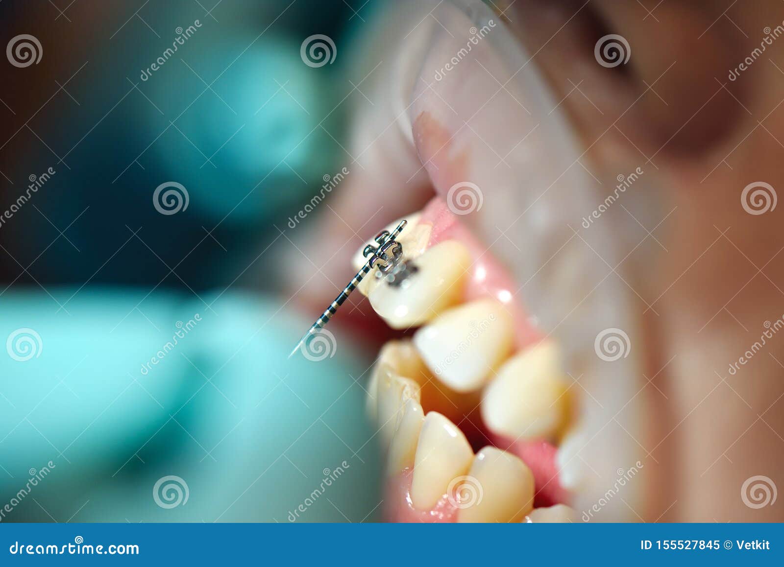 Installation of Braces by the Dentist Stock Image Image of doctor