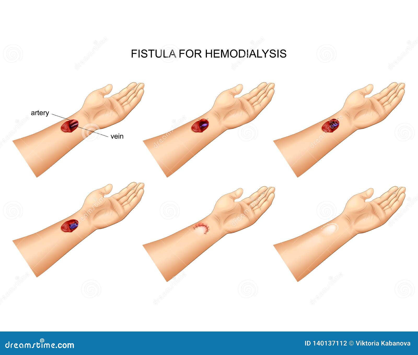 installation of fistula for hemodialysis