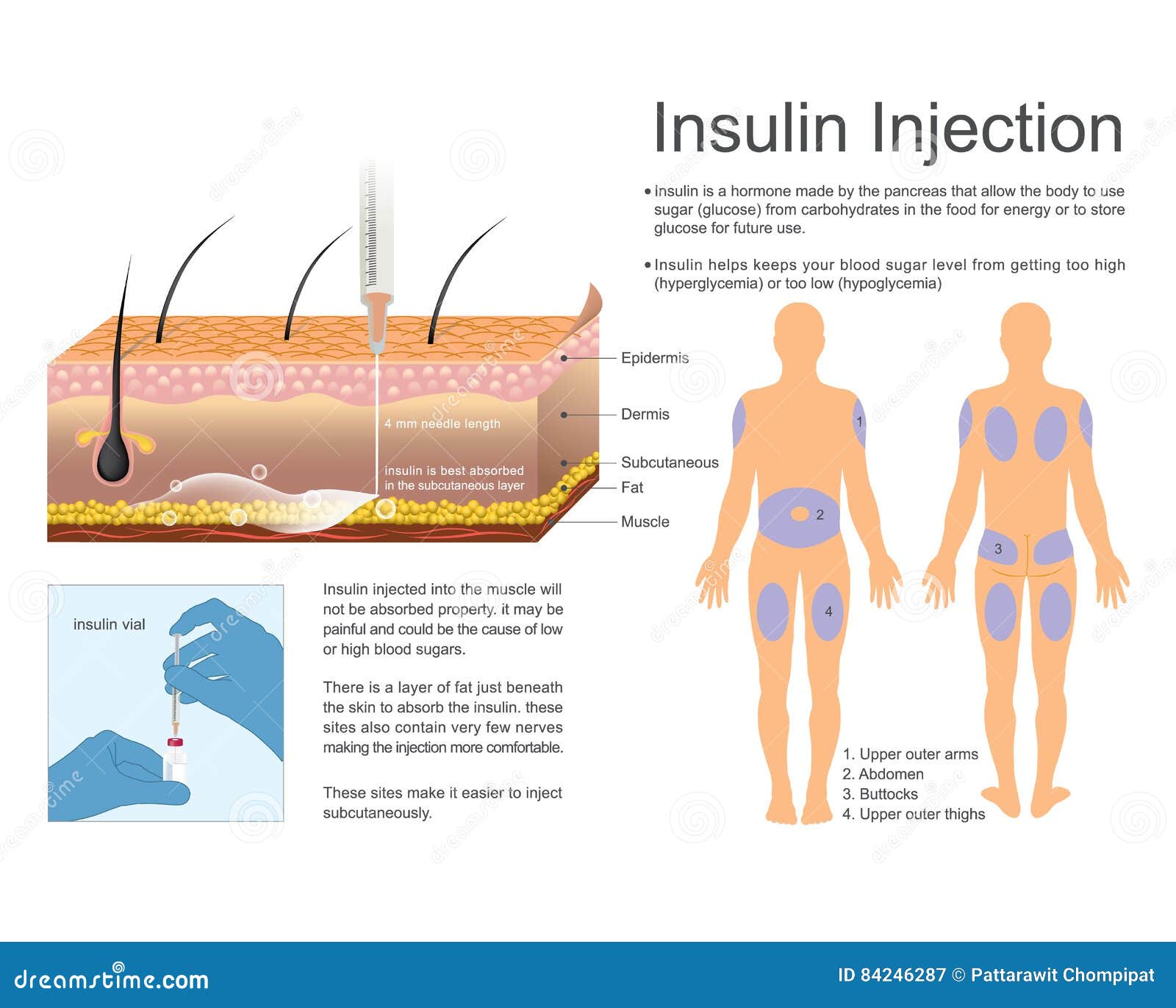 Injection sites for insulin injections diagram