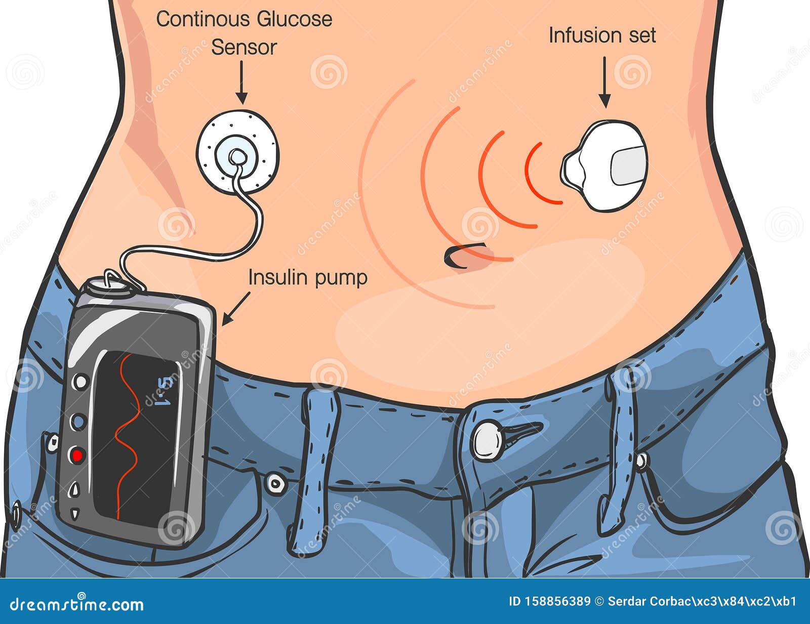 Insulin Pumps for Diabetes Patients Vector Ä°llustration Stock Vector