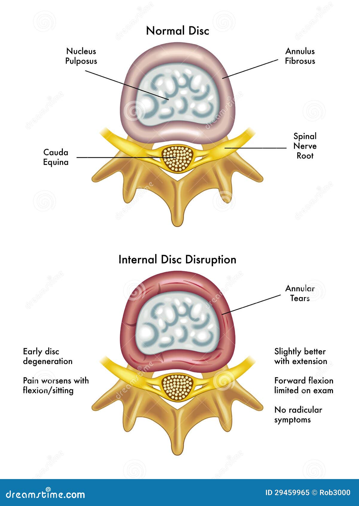 internal disc disruption