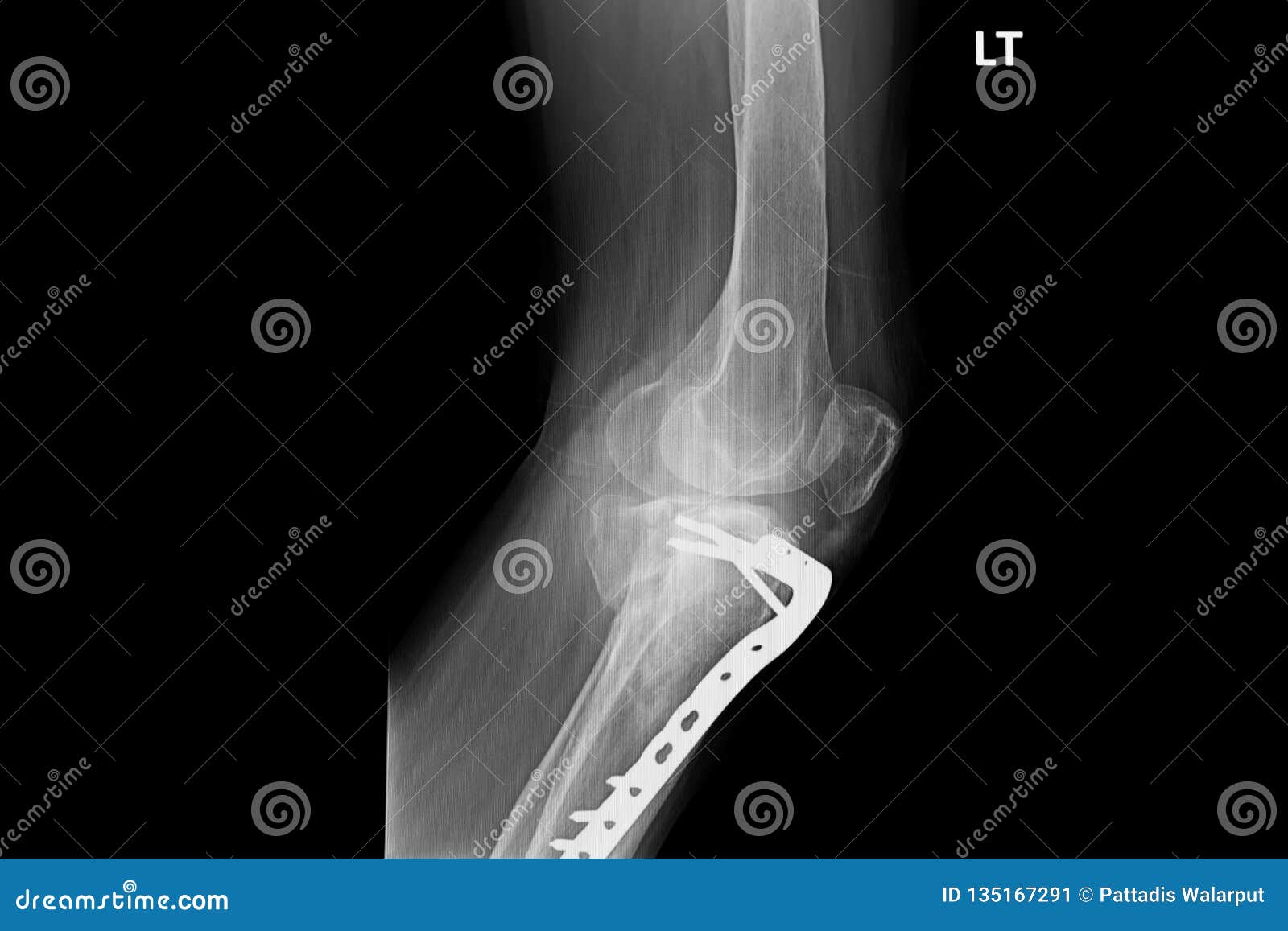 Internal of Left Leg Fixed with Plate and Screws Stock Image Image of