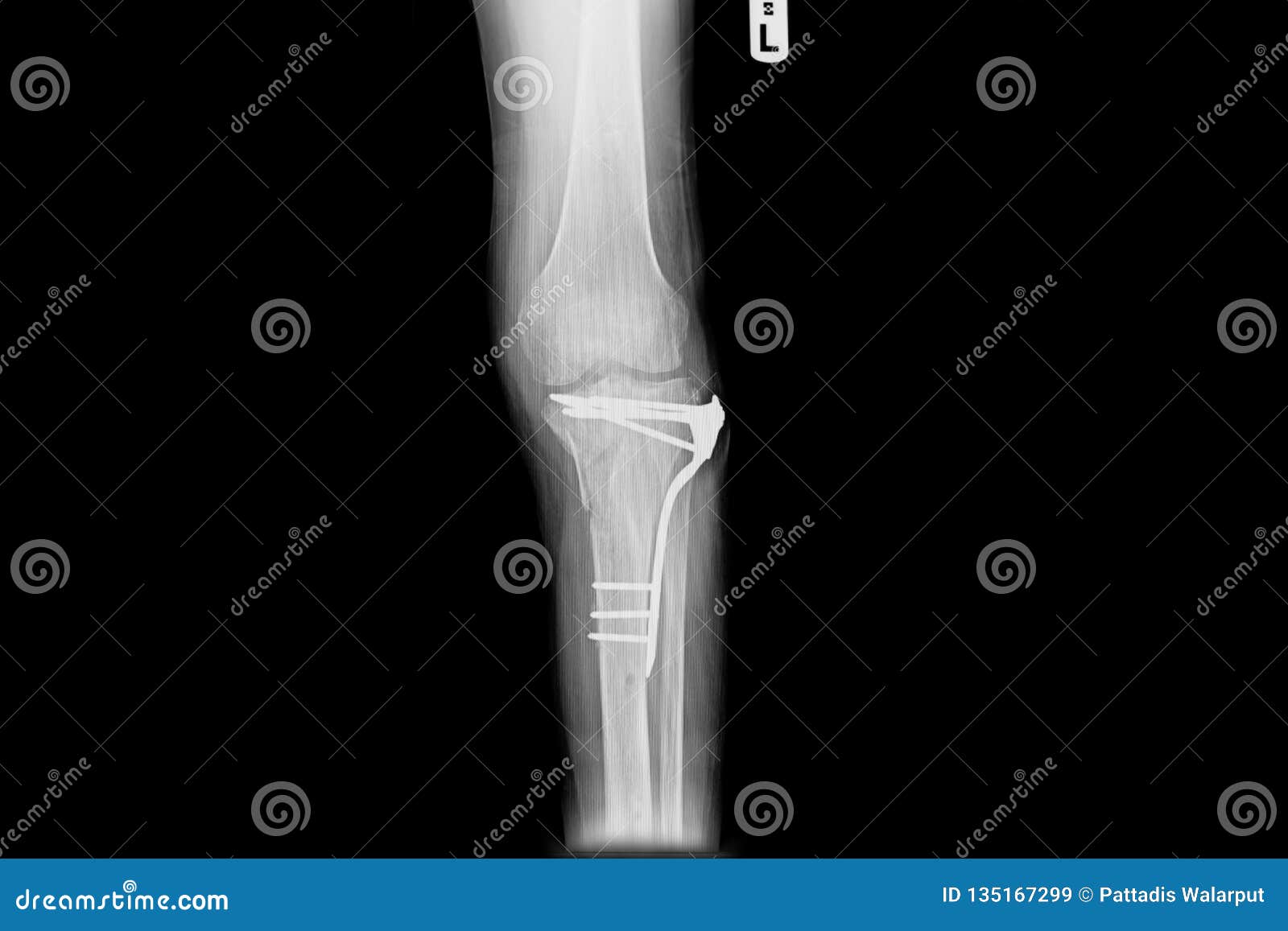 Internal of Left Leg Fixed with Plate and Screws Stock Image Image of