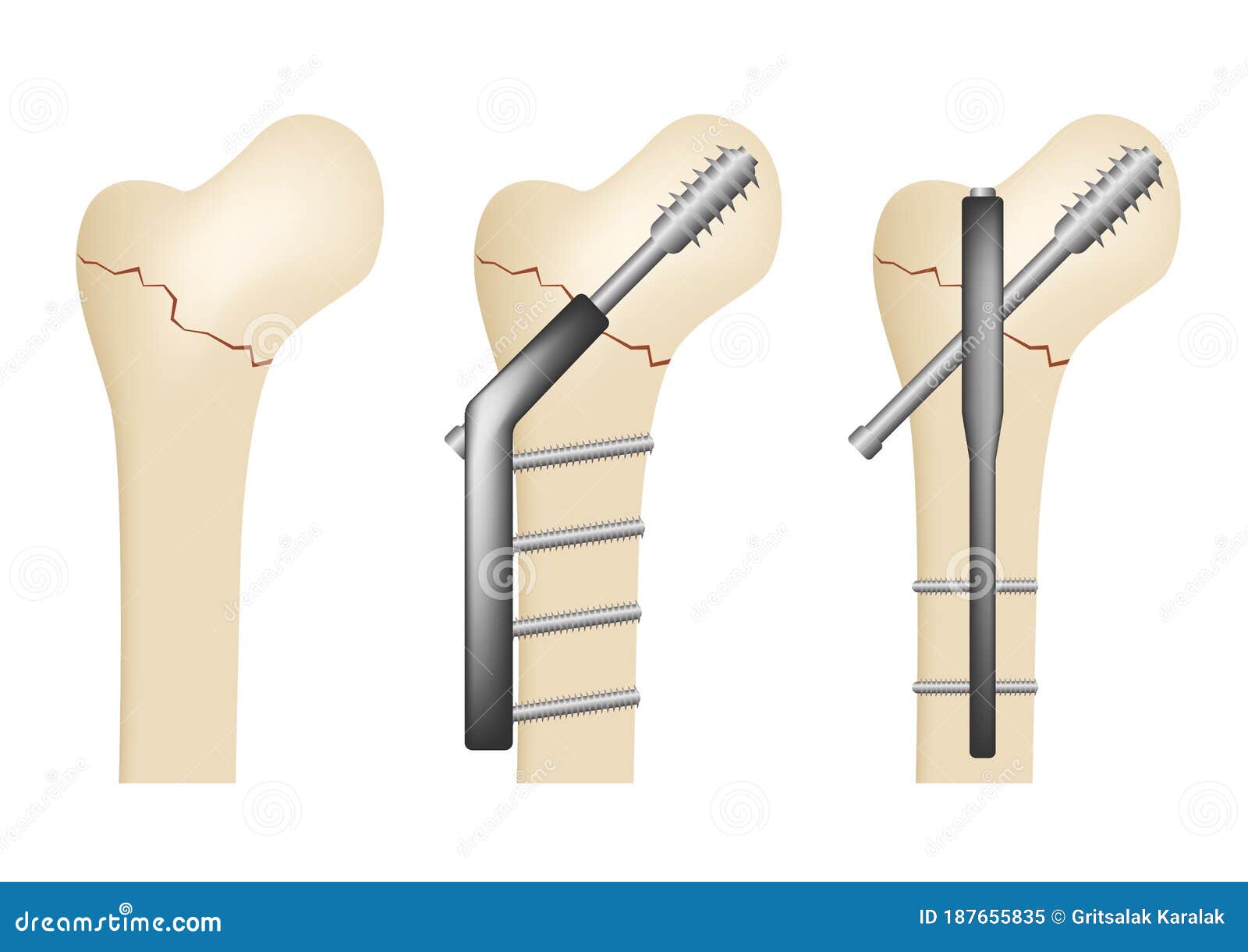 Intertrochanteric fracture of bone vector white background