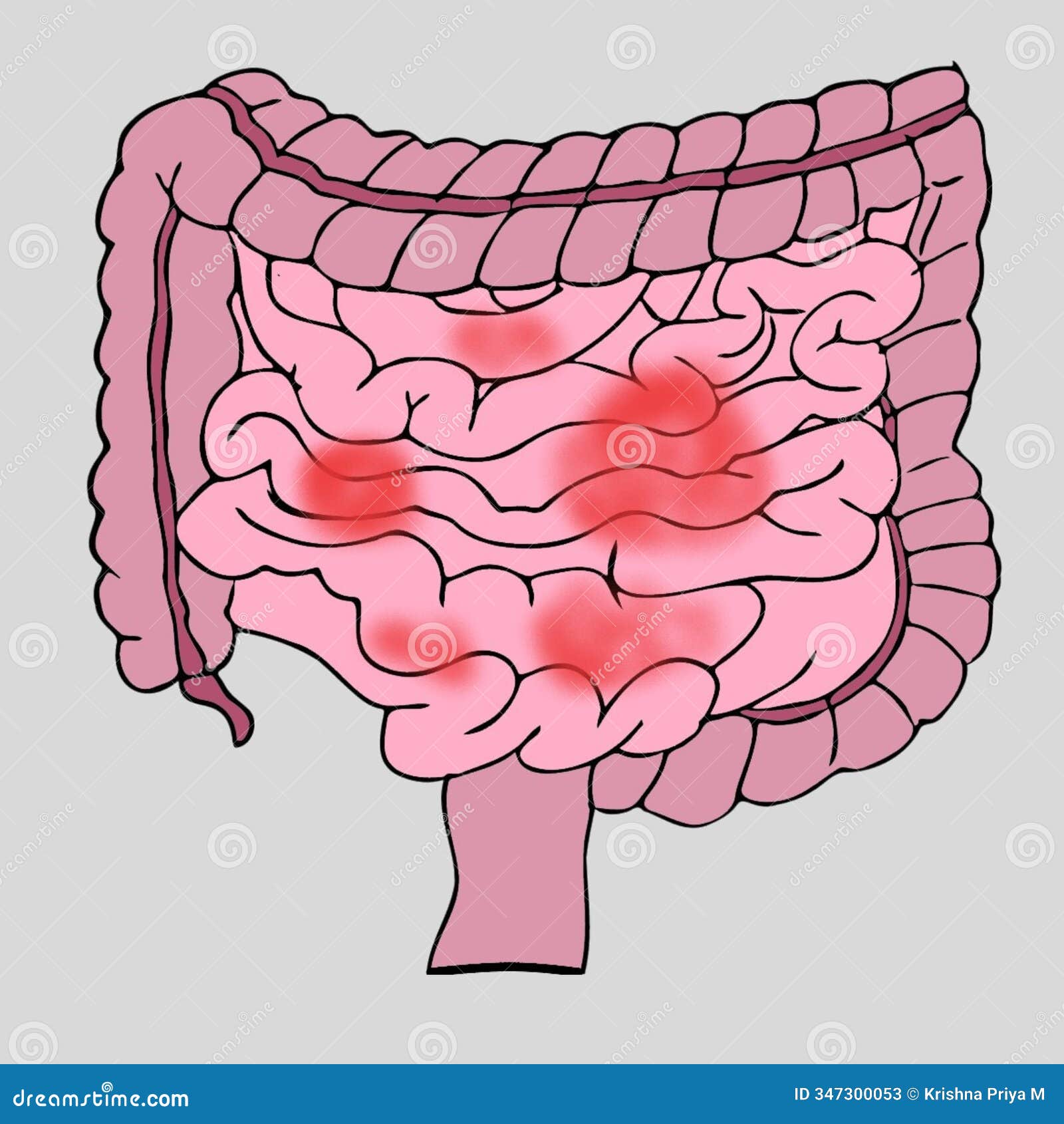 Intestinal Inflammation Illustration Biology Stock Illustration Intestinal Inflammation Illustration Biology Stock Illustration