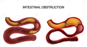 Ileus Clipart And Illustrations