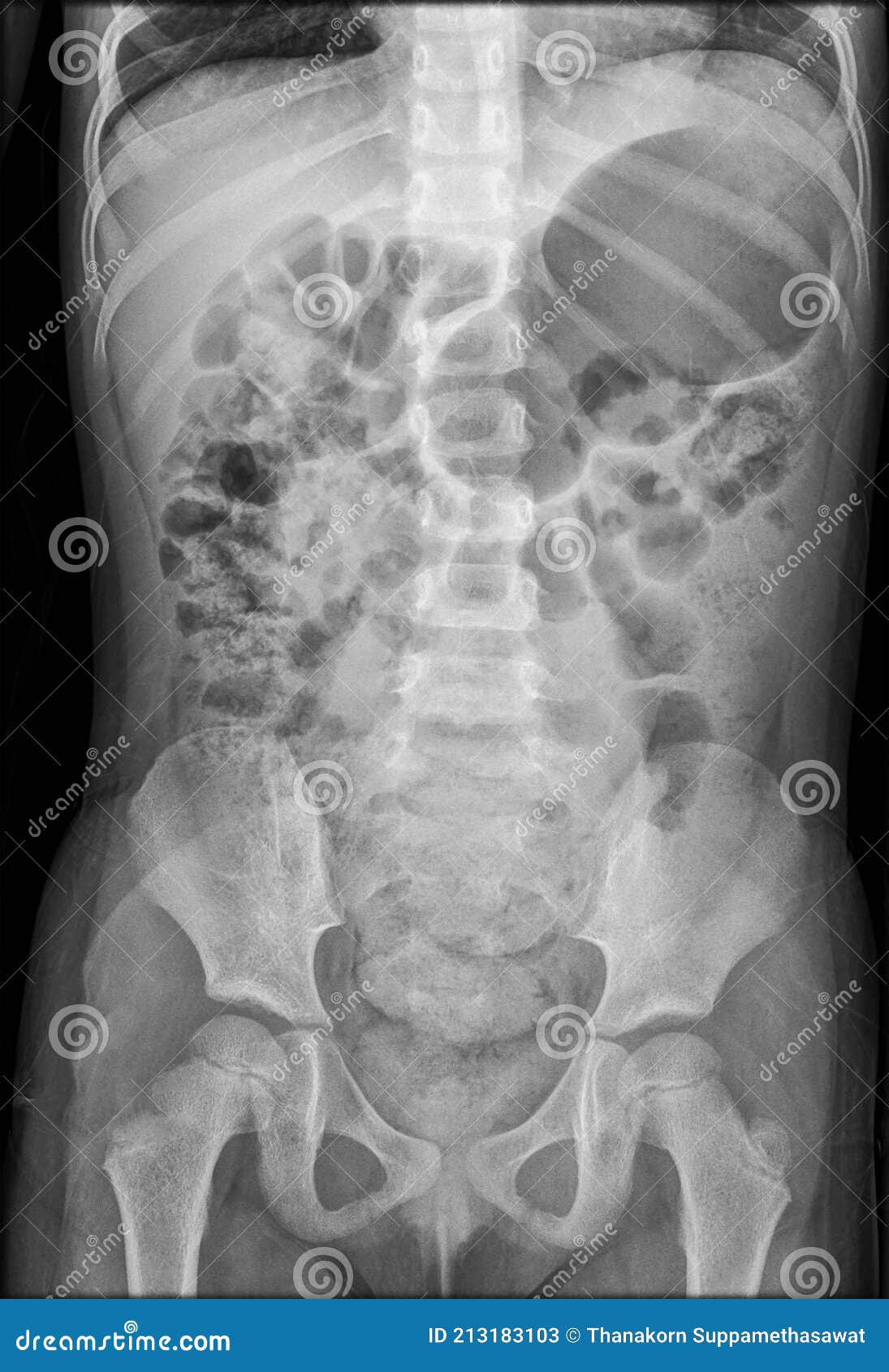 Intestinal Obstruction In A Child X Ray Film X ray Body Of Child Stock intestinal-obstruction-in-a-child-x-ray-film-x-ray-body-of-child-stock