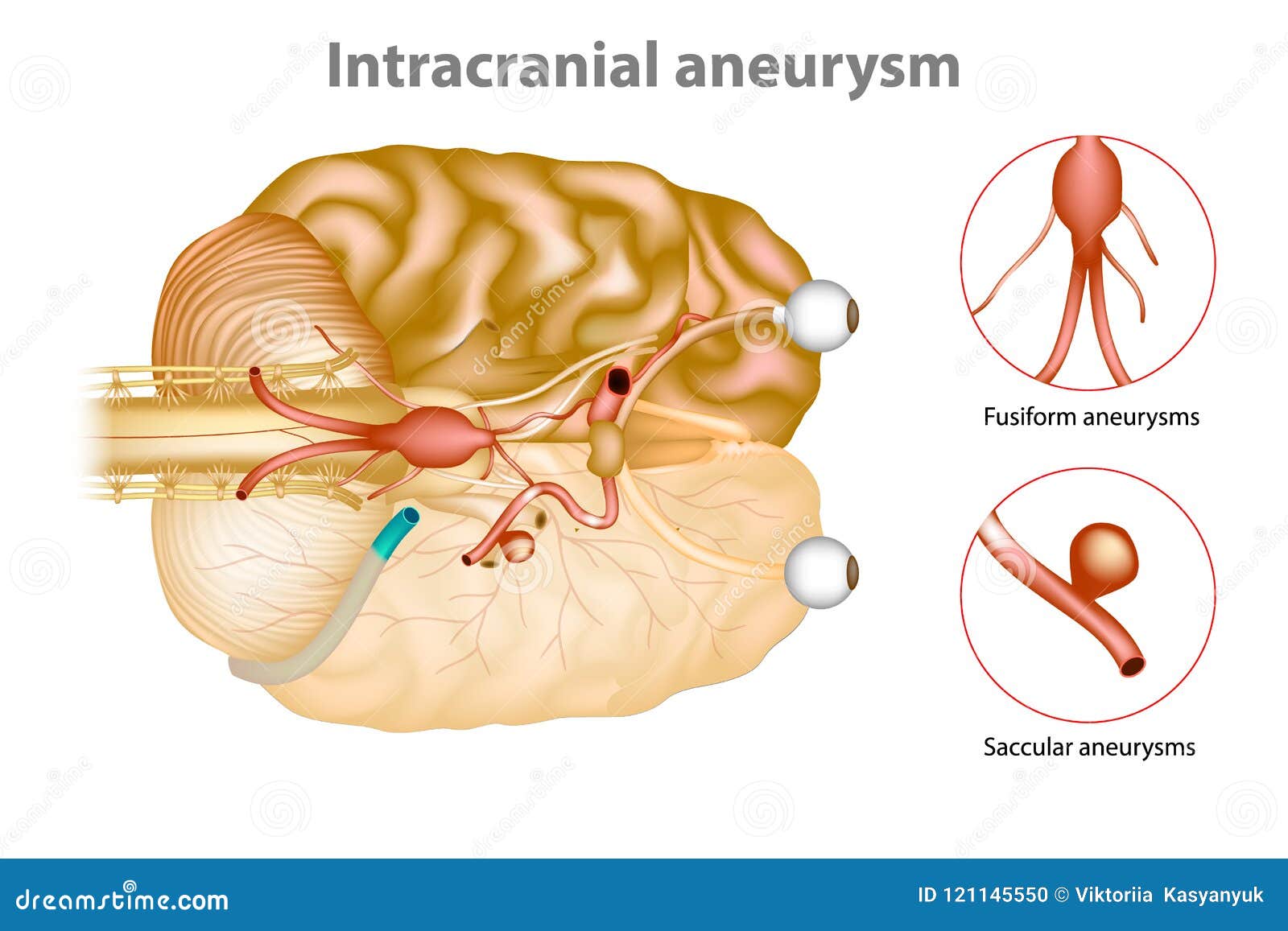 intracranial aneurysm or brain aneurysm.